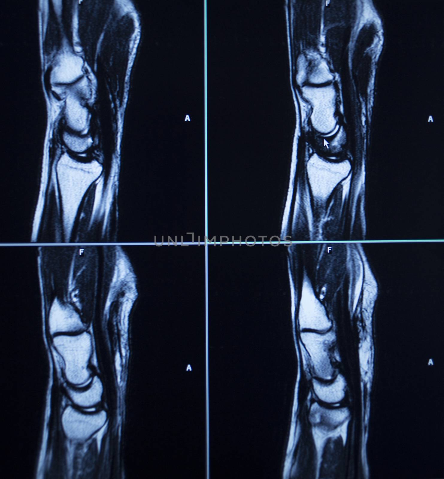 MRI scan test results wrist hand injury by edwardolive