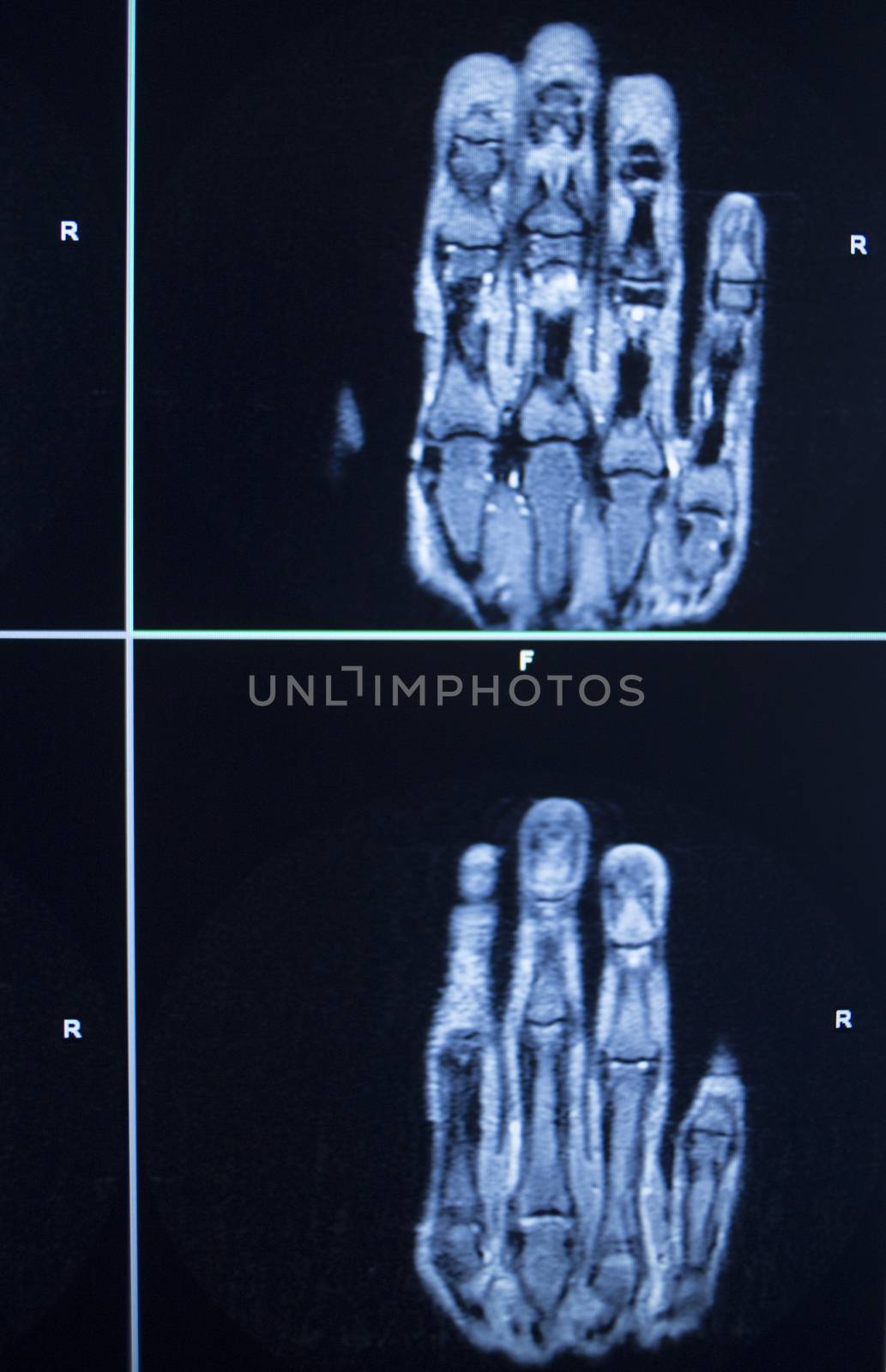 MRI magentic resonance imaging nuclear scanning scan test results hand fingers injury photo.