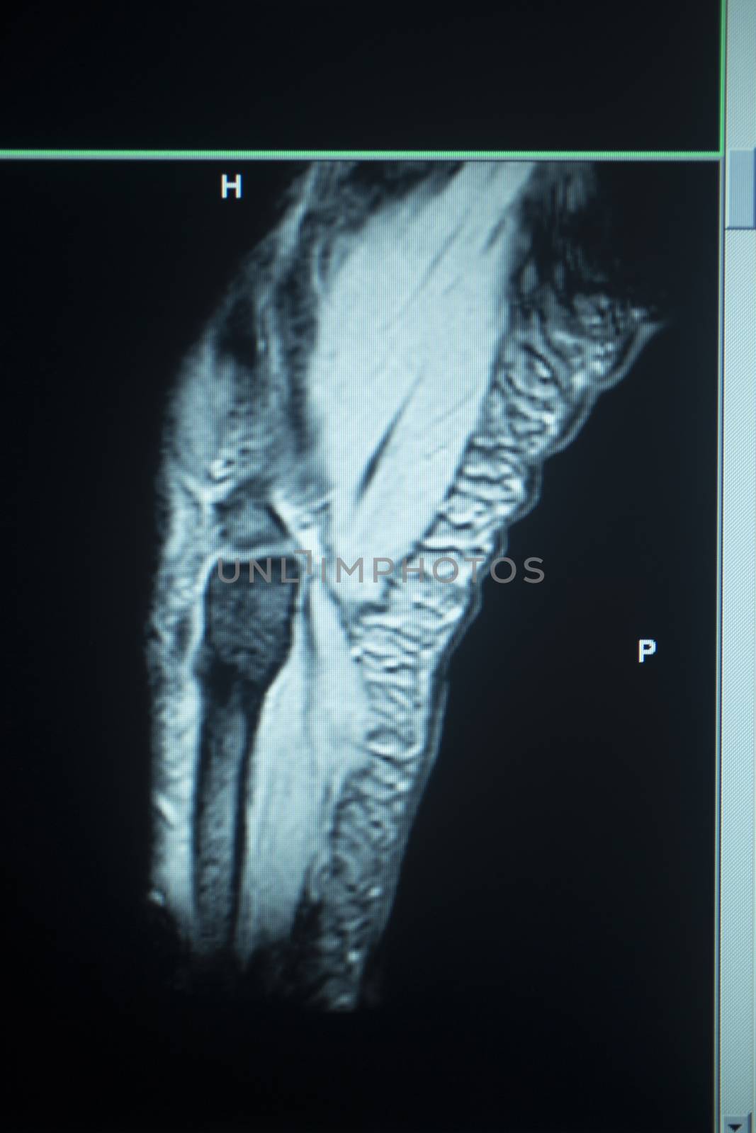 MRI magentic resonance imaging nuclear scanning scan test results tennis elbow arm injury photo.