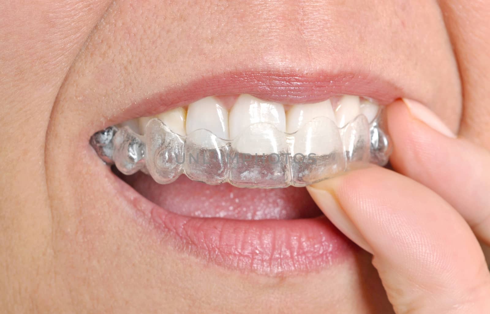 Woman putting in her invisible braces