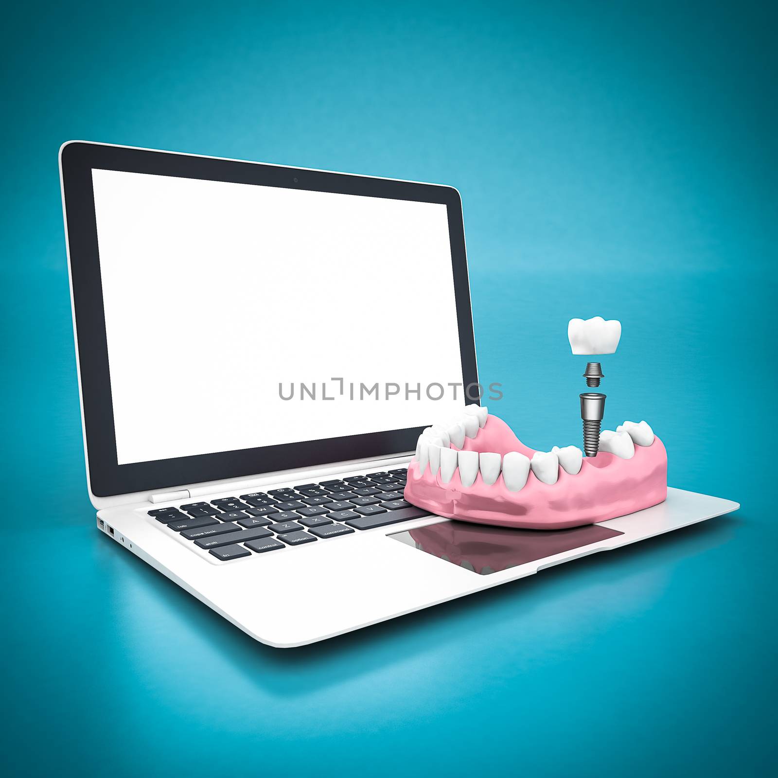 picture of dental implants on a blue background