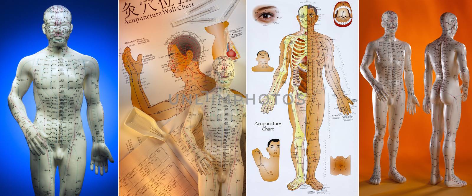 Acupuncture is a system of complementary medicine that involves pricking the skin or tissues with needles, used to alleviate pain and to treat various physical, mental, and emotional conditions. Originating in ancient China, acupuncture is now widely practiced in the West.