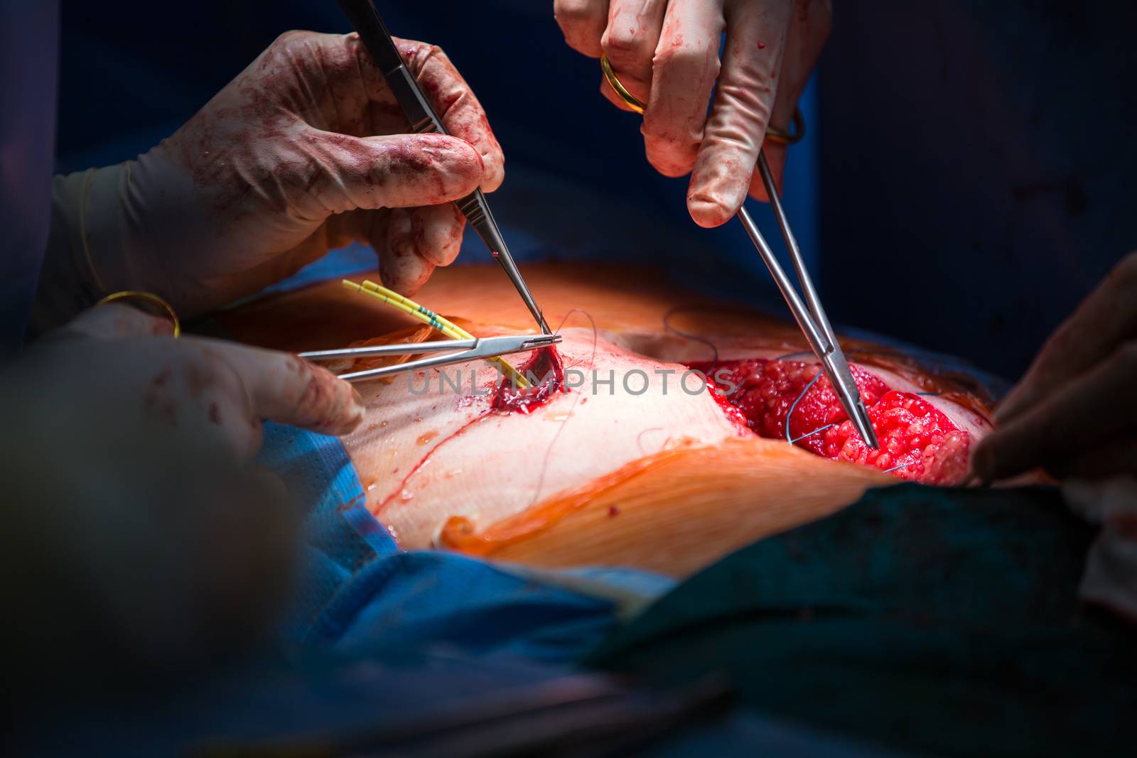 Surgery in a modern hospital being performed by a team of profes by viktor_cap