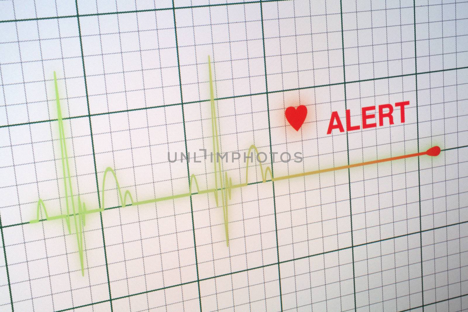 Flat line alert on a heart monitor.