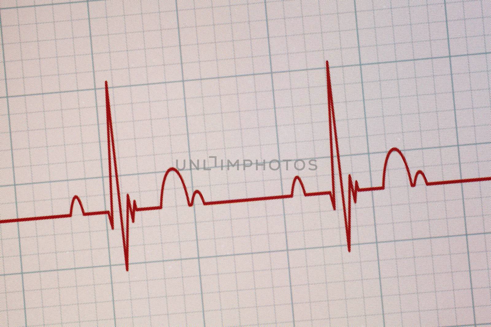 Flatline blip on a medical heart monitor ECG / EKG (electrocardiogram) with white background