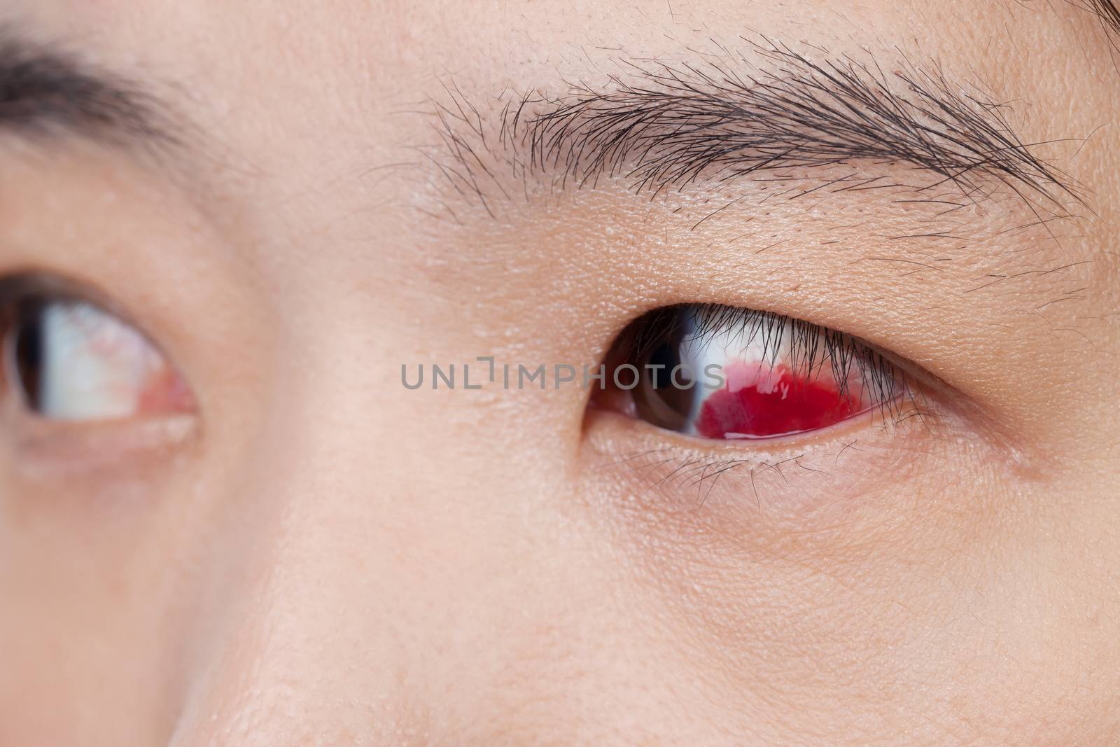 Eye injury or infected for healthy concept, macro closeup  by FrameAngel