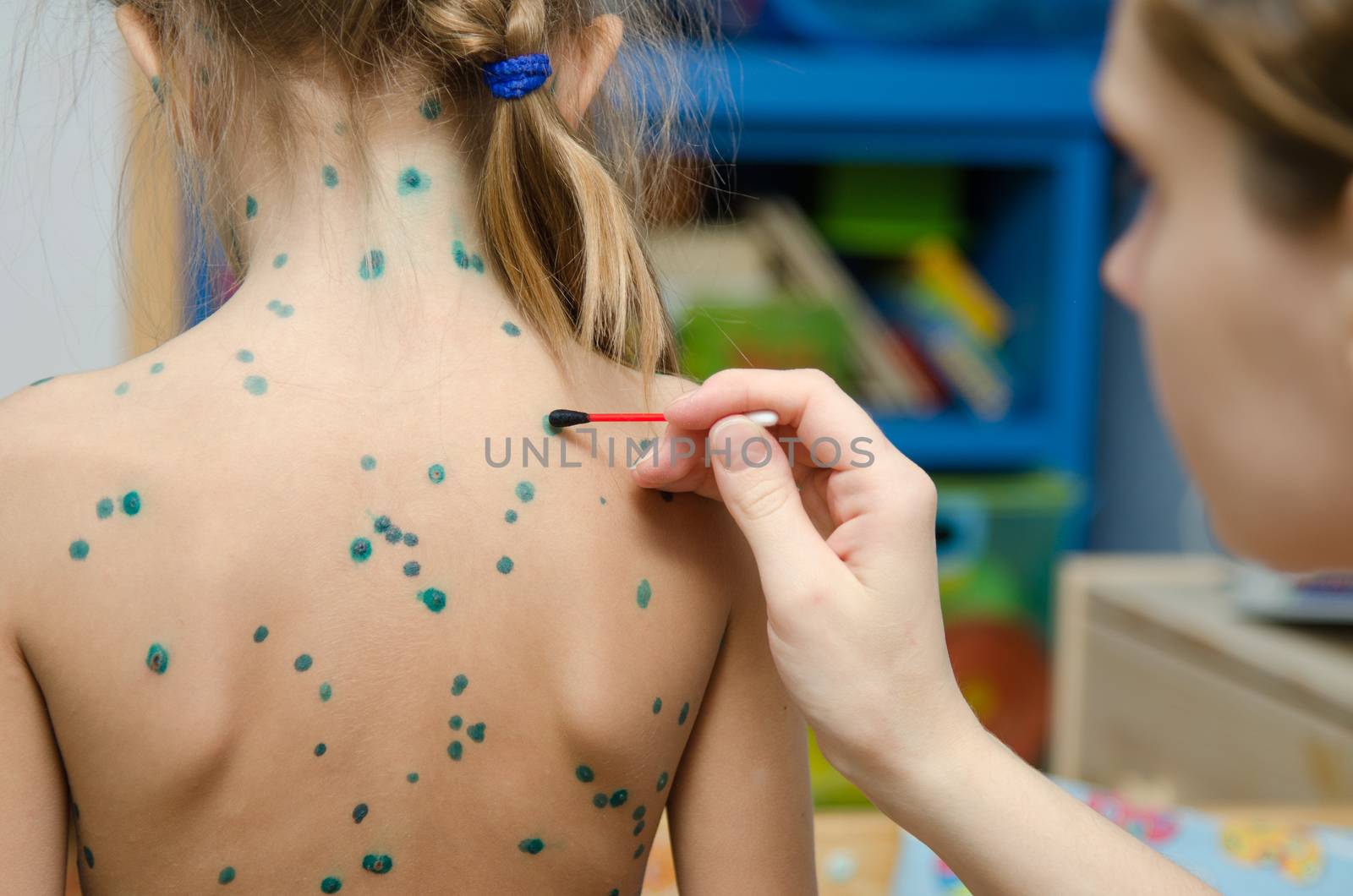 Lubrication zelenkoj chickenpox sores on the back of a little girl