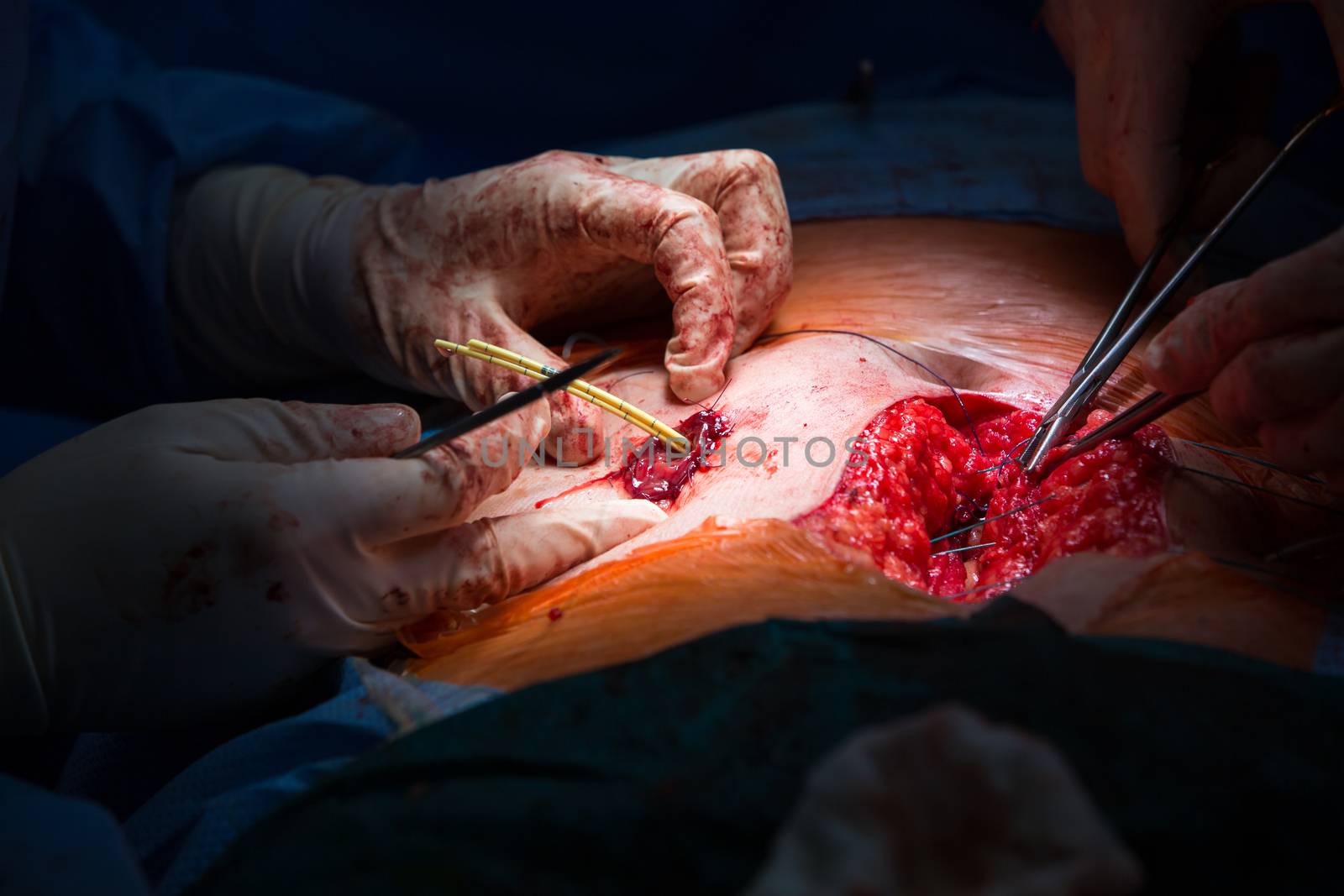 Surgery in a modern hospital being performed by a team of professionals (shallow DOF, color toned image)