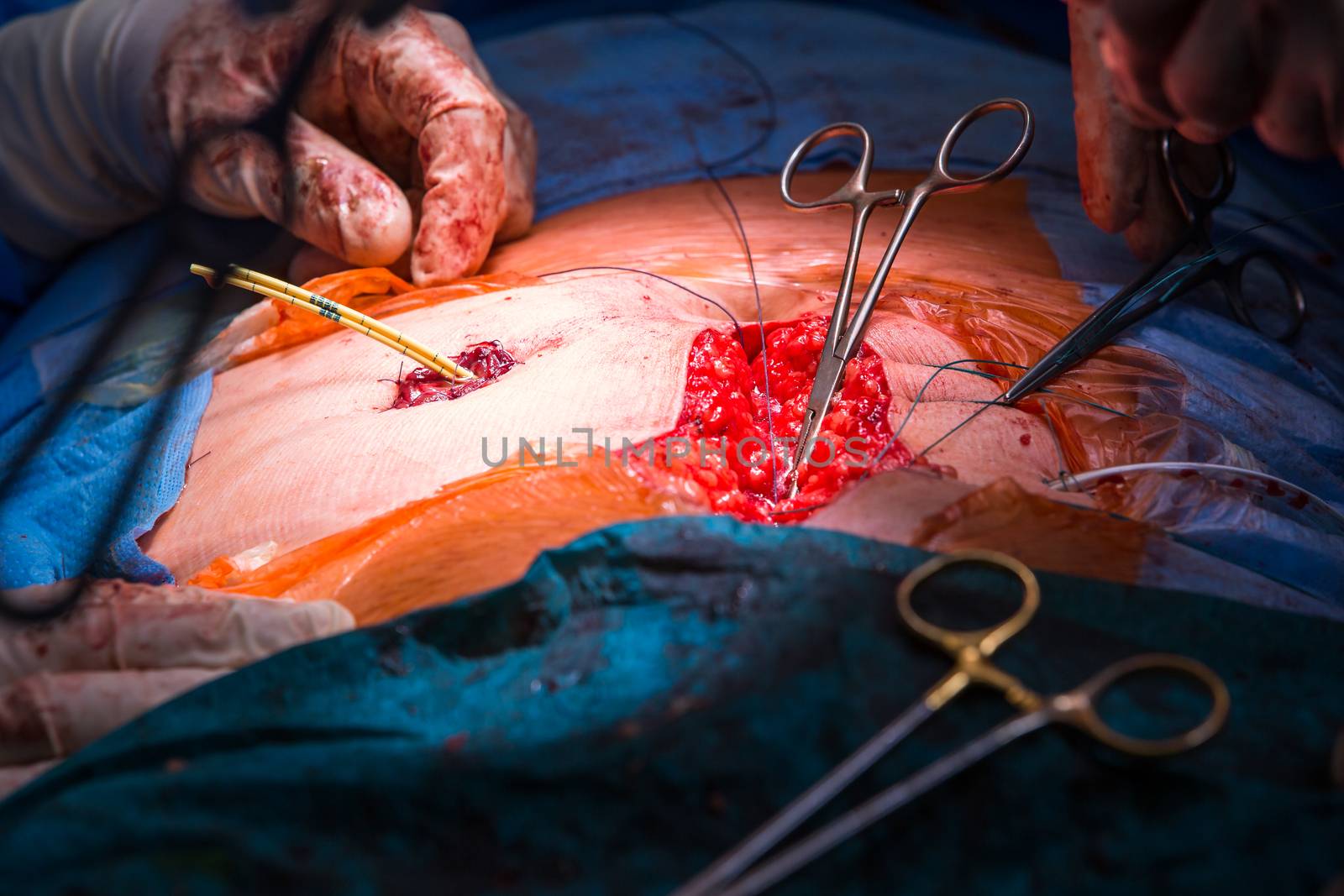 Surgery in a modern hospital being performed by a team of professionals (shallow DOF, color toned image)