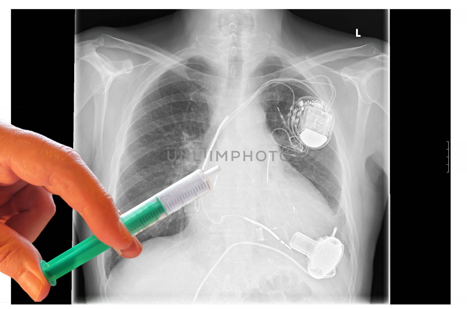 X-ray left side of the chest. Vergößertes heart with implanted pacemaker system. Below are the pump of the heart assist system. Hand with syringe in the image.