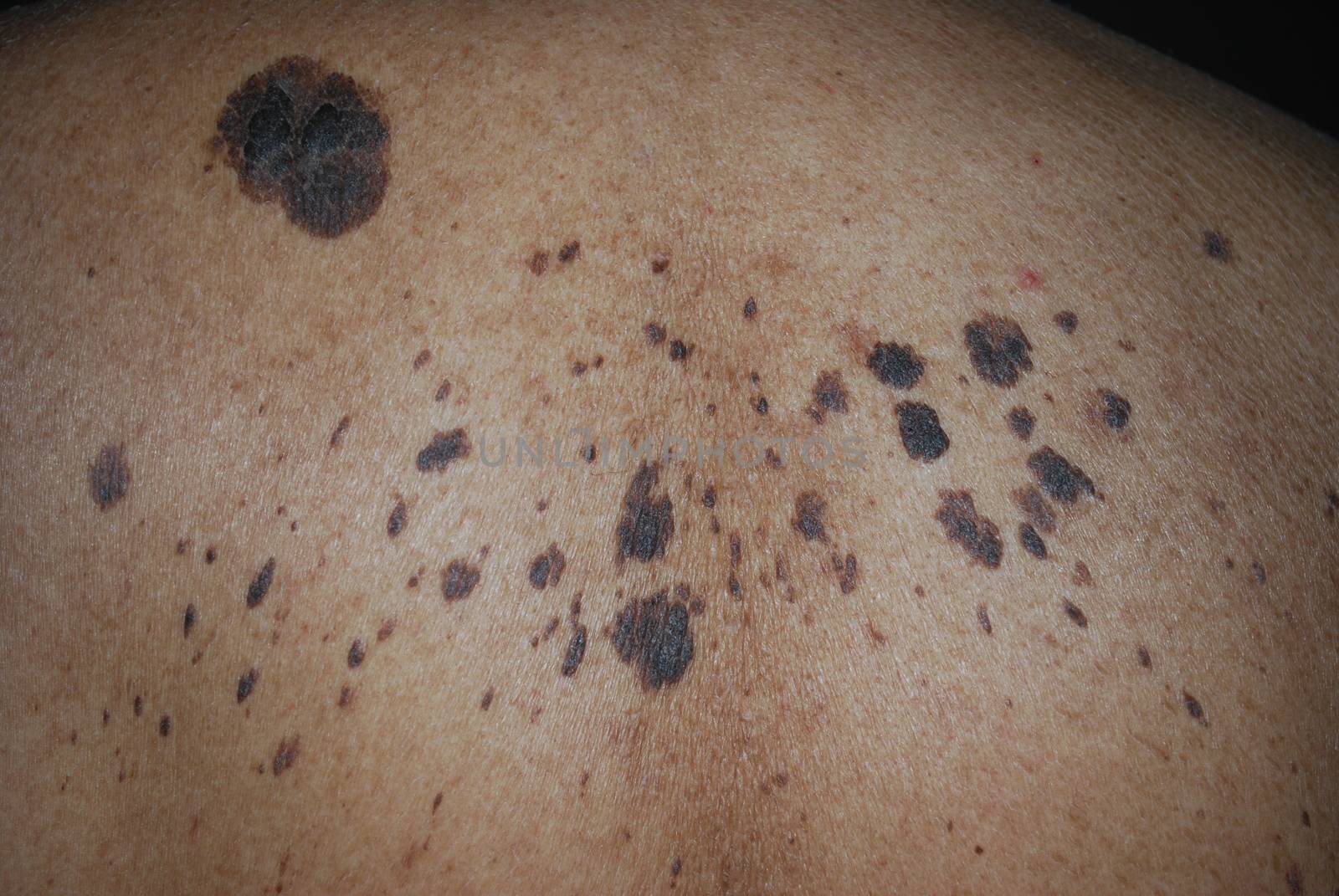 Cancerous moles on the back of a man.