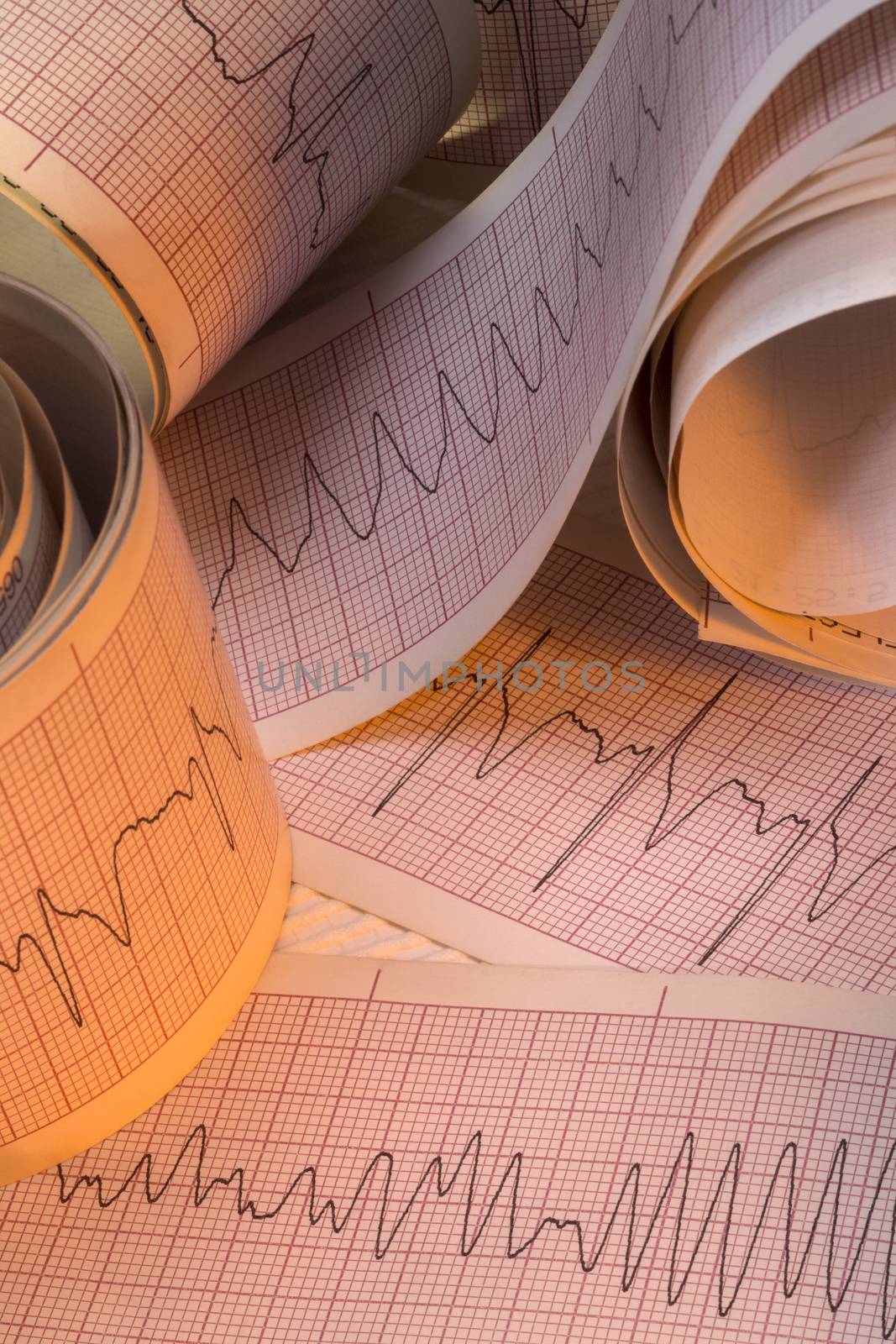 Electrocardiograph traces of Cardiac Arrhythmia including Ventricular Fibrallation (VF) and Ventricular Tachycardia (VT). Also known as cardiac dysrhythmia, this a group of conditions in which the heartbeat is irregular, too fast, or too slow. VT and VF can lead to cardiac arrest and death.