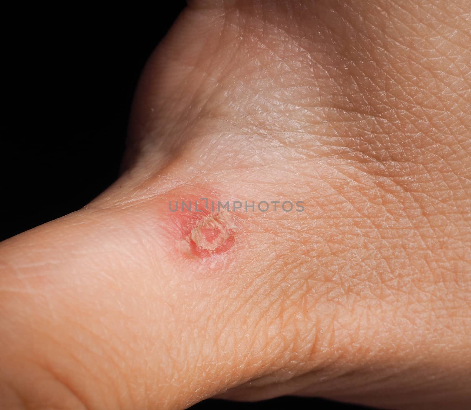 Closeup of injury on hand below thumb isolated towards black background