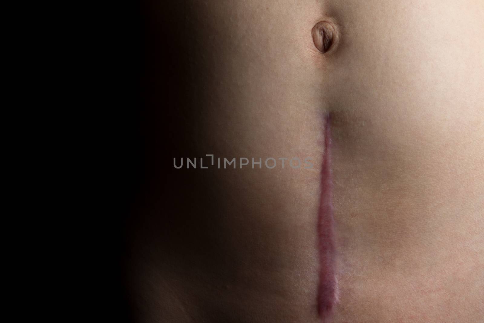 A recovering scar from a c-section operation dramatically faded to black.