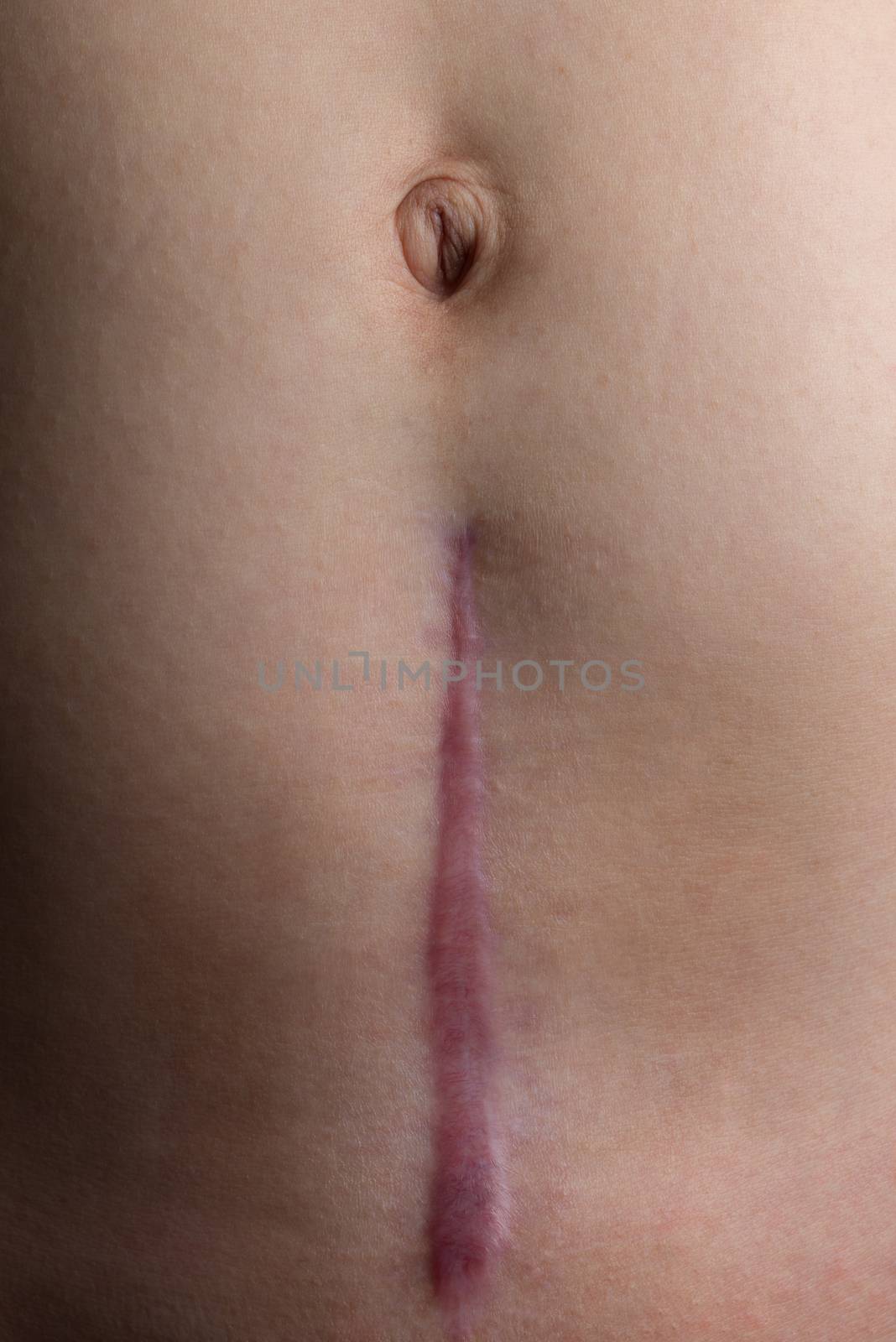 Recovering C-Section Scar by justtscott