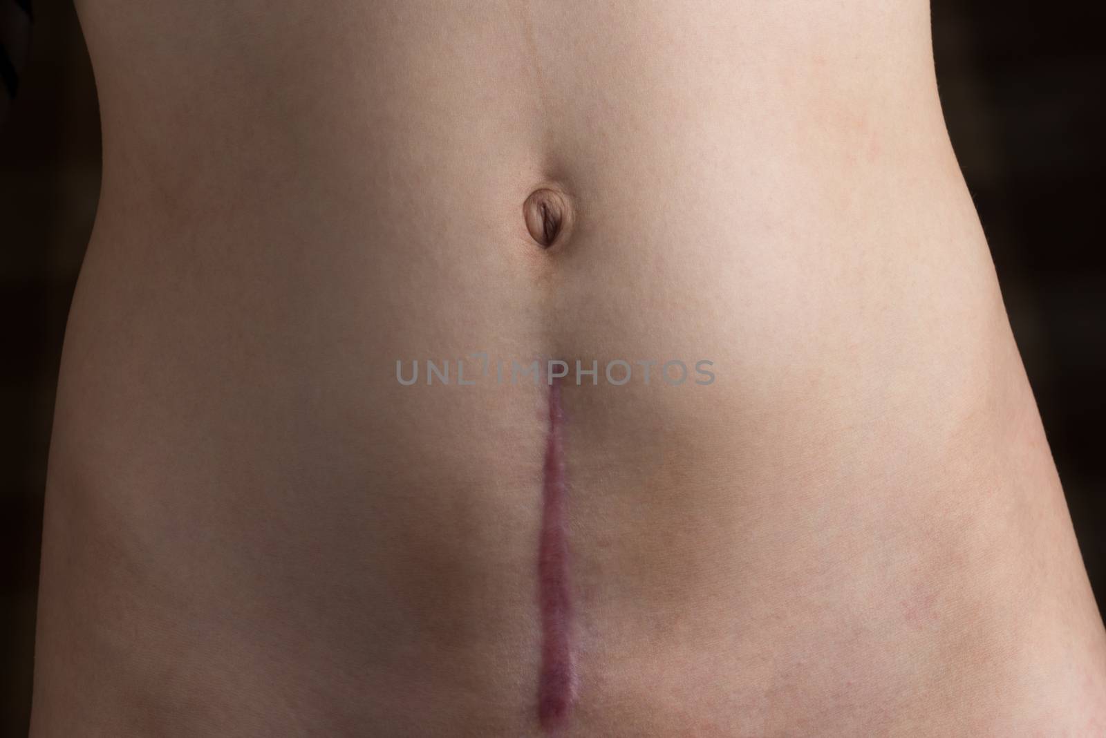 Recovering C-Section Scar by justtscott