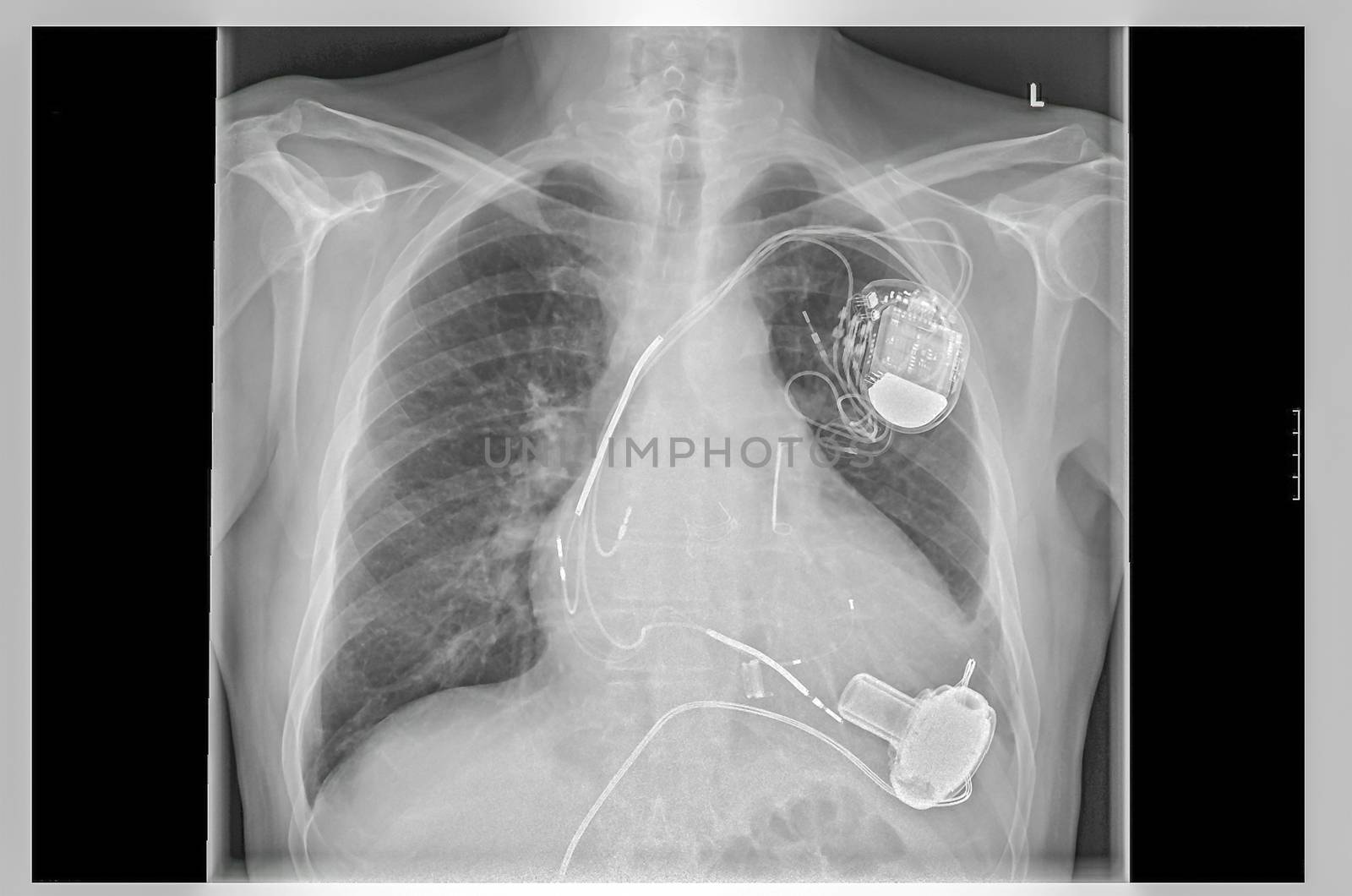 Radiograph left side of the chest. Vergößertes heart with implanted pacemaker system. Below are the pump of the heart assist system.