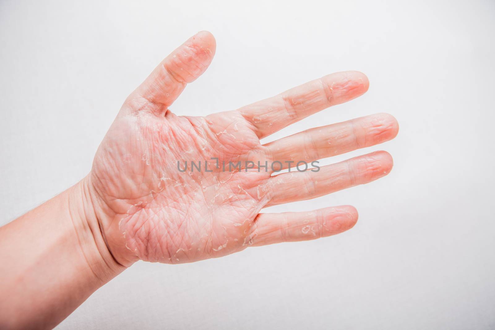 The problem with many people - eczema on hand. Isolated background.