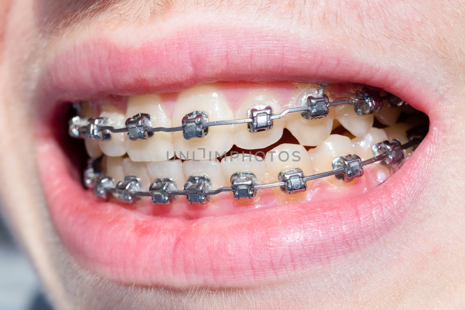 Mouth of teenage boy with bracket teeth and lips