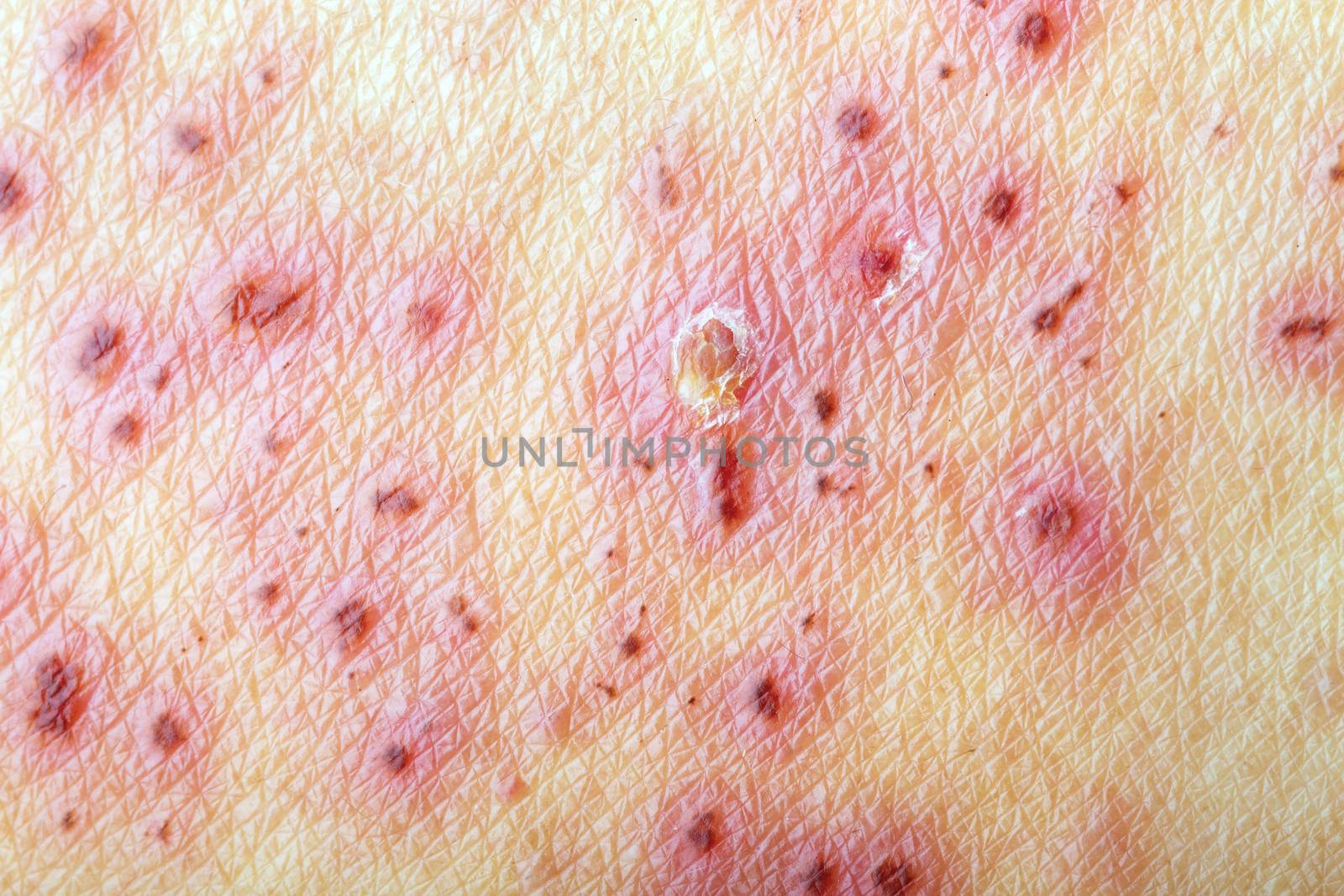 After treatment of skin with Herpes Zoster (Shingles)