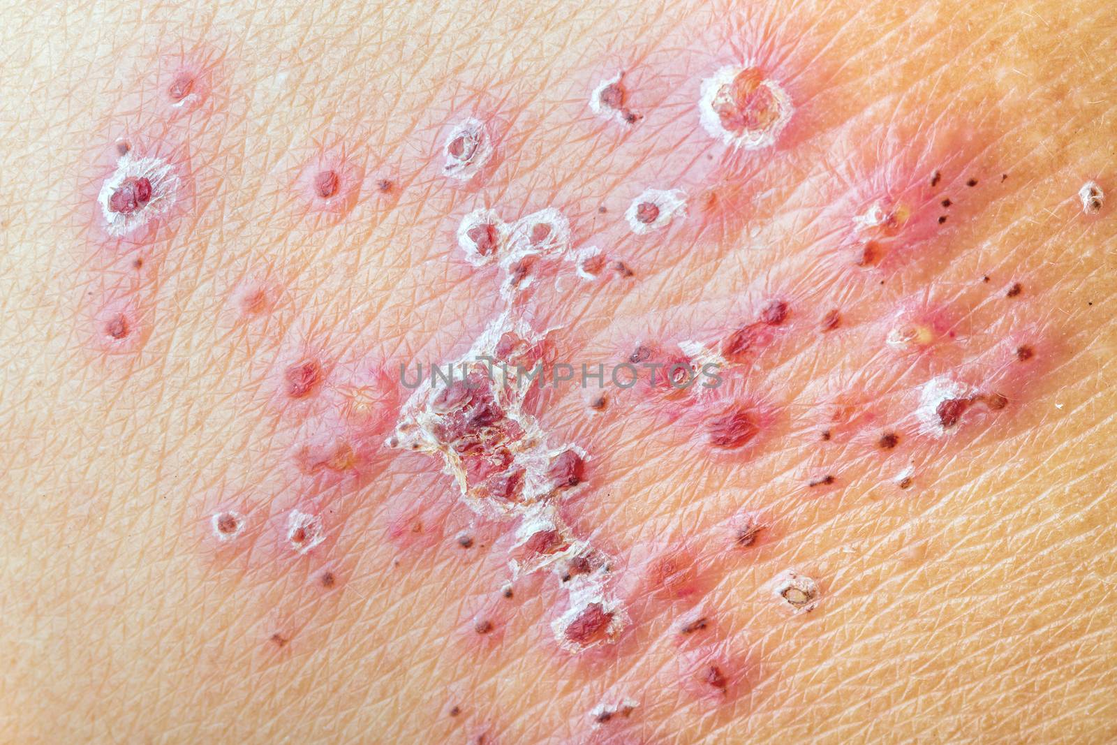 After treatment of skin with Herpes Zoster (Shingles)