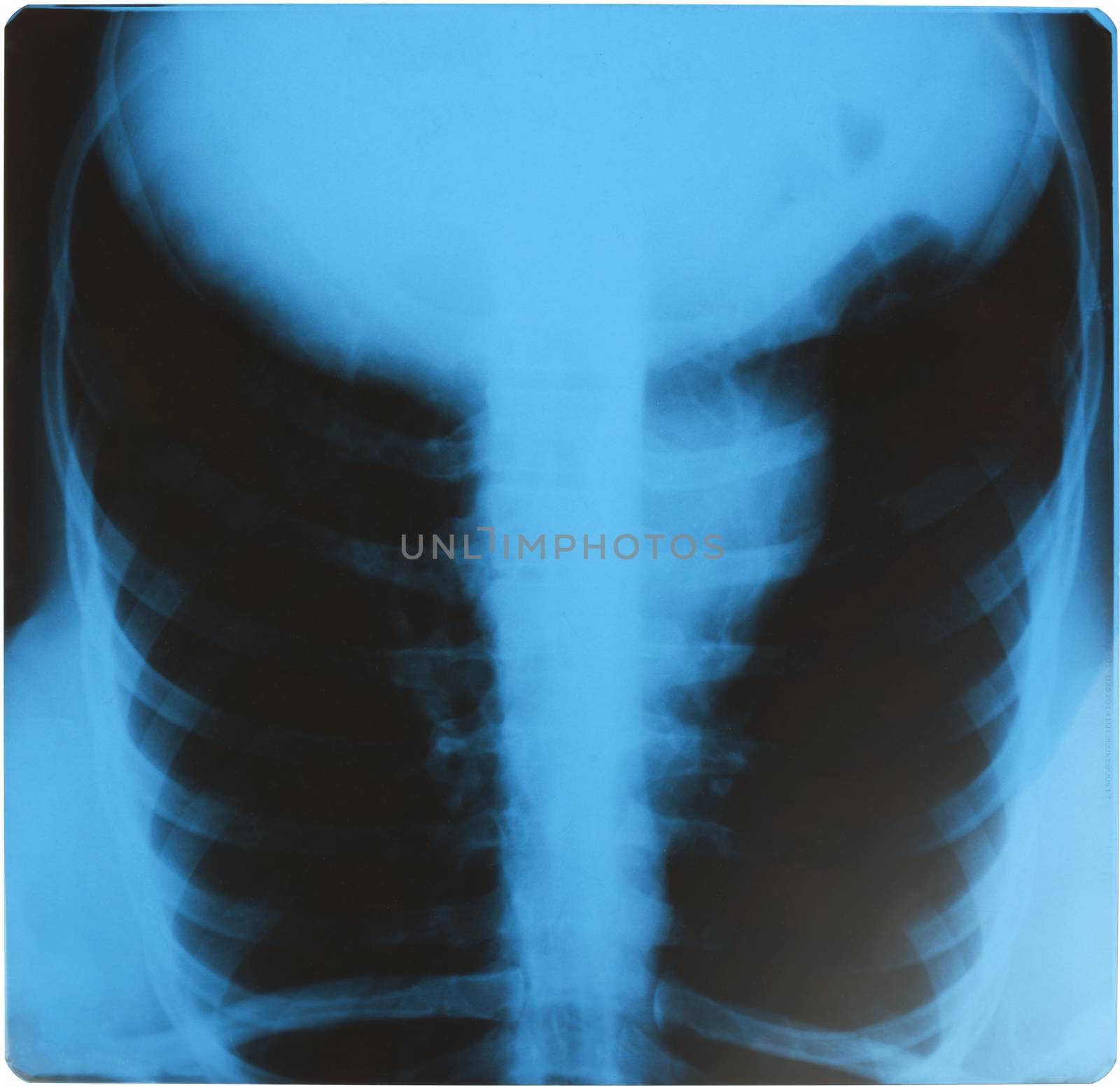 X-ray examination of human chest on picture