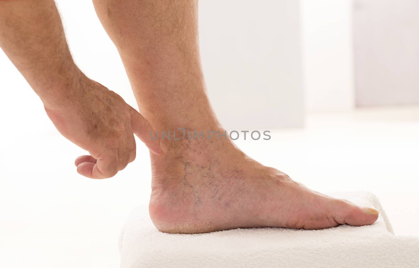 Varicose veins closeup, foot on modular bath step