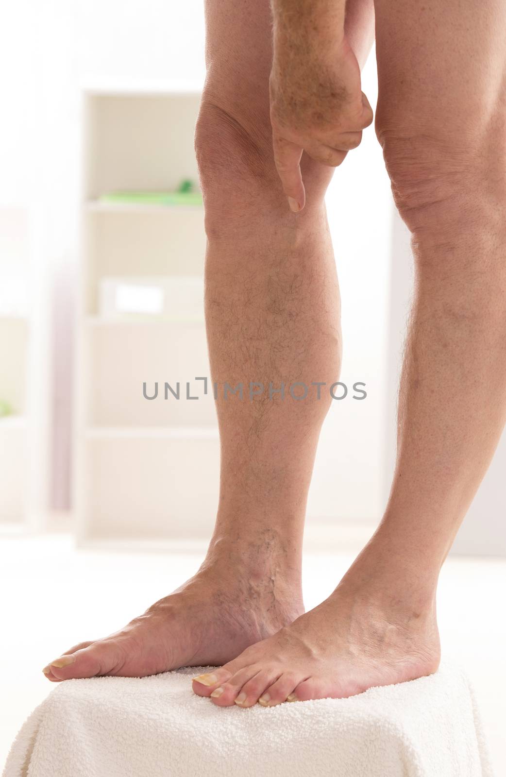Varicose veins closeup, foot on modular bath step