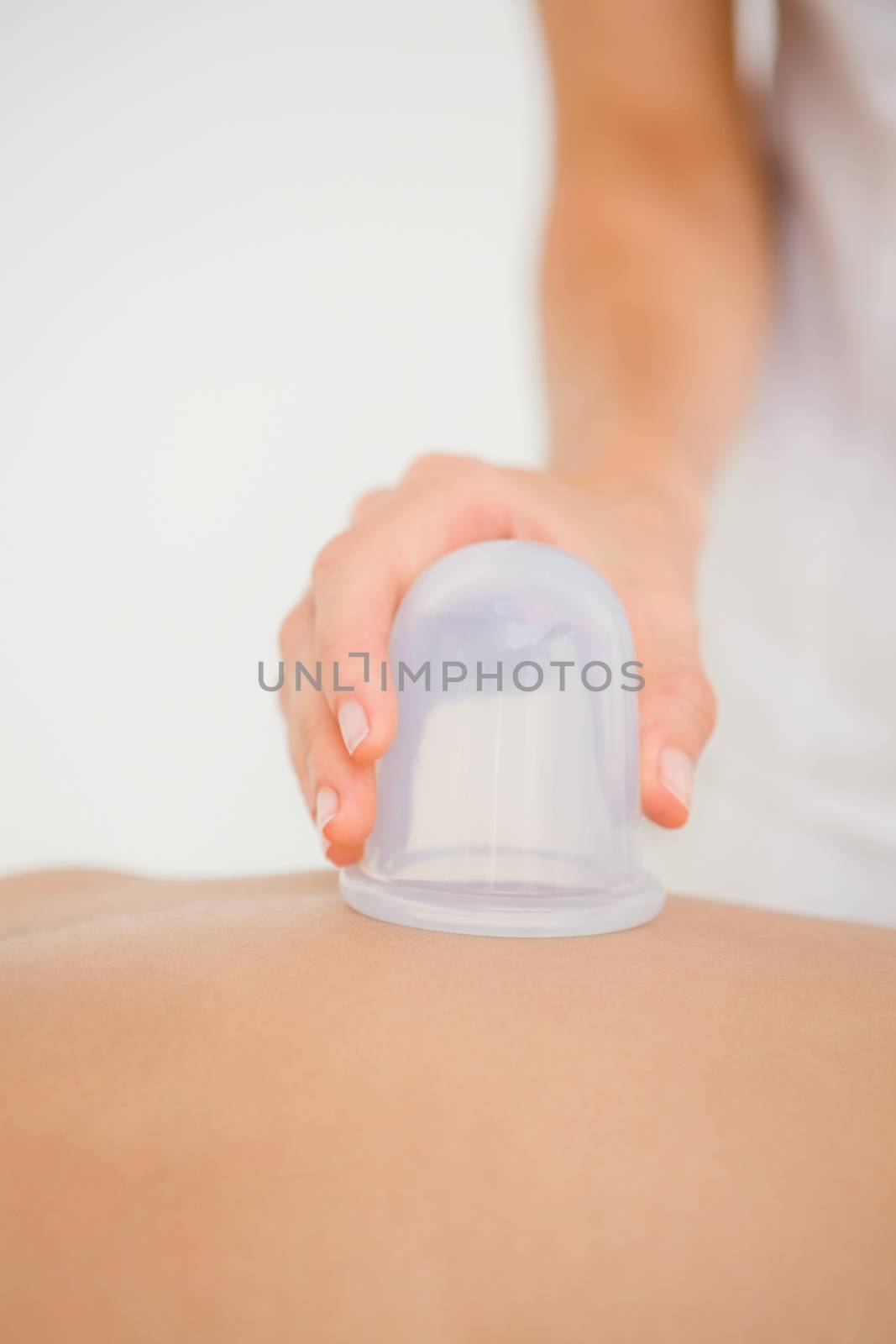 Woman with vacuum cups on her back at the health spa