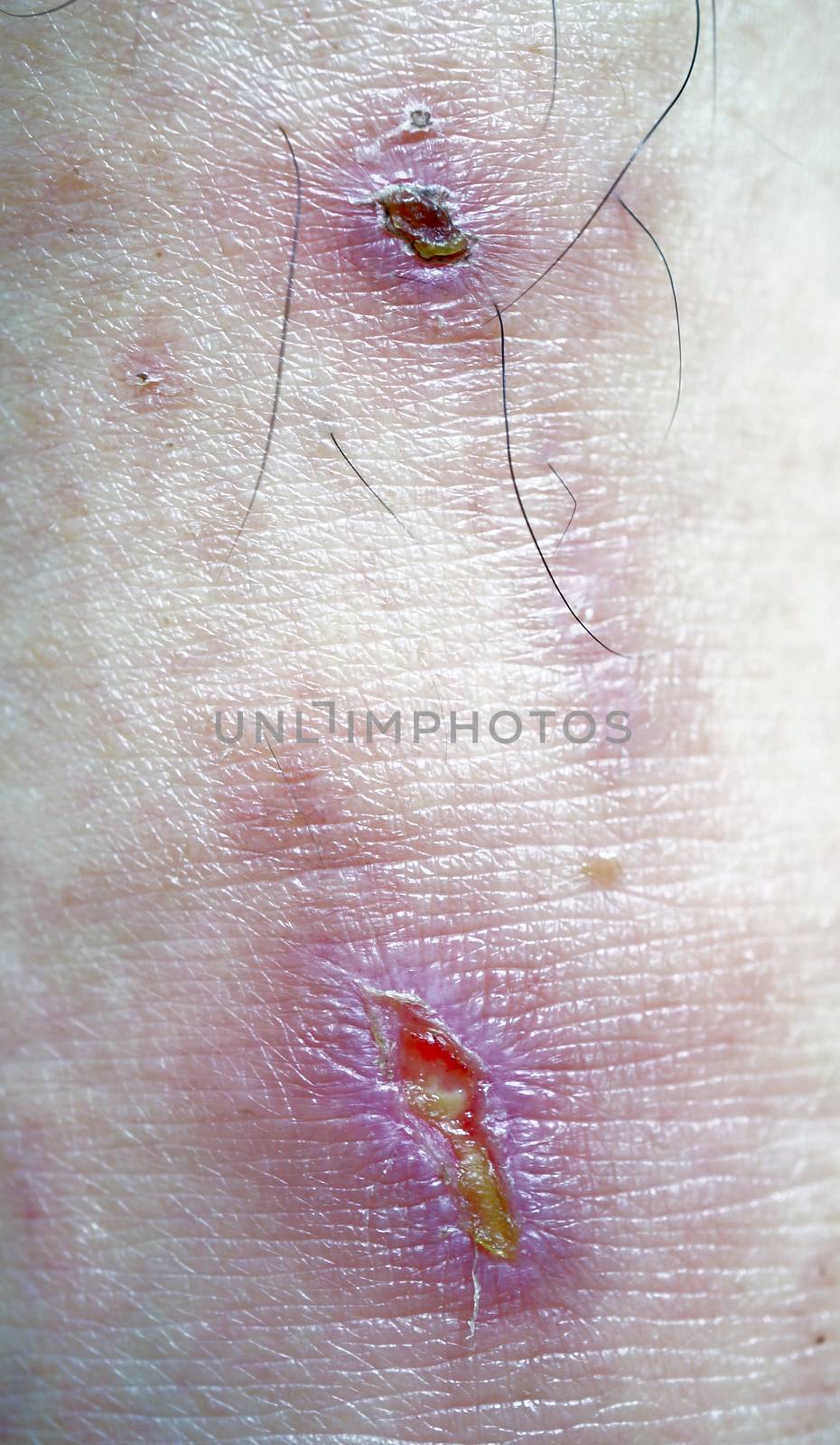 Wound at leg by ninun