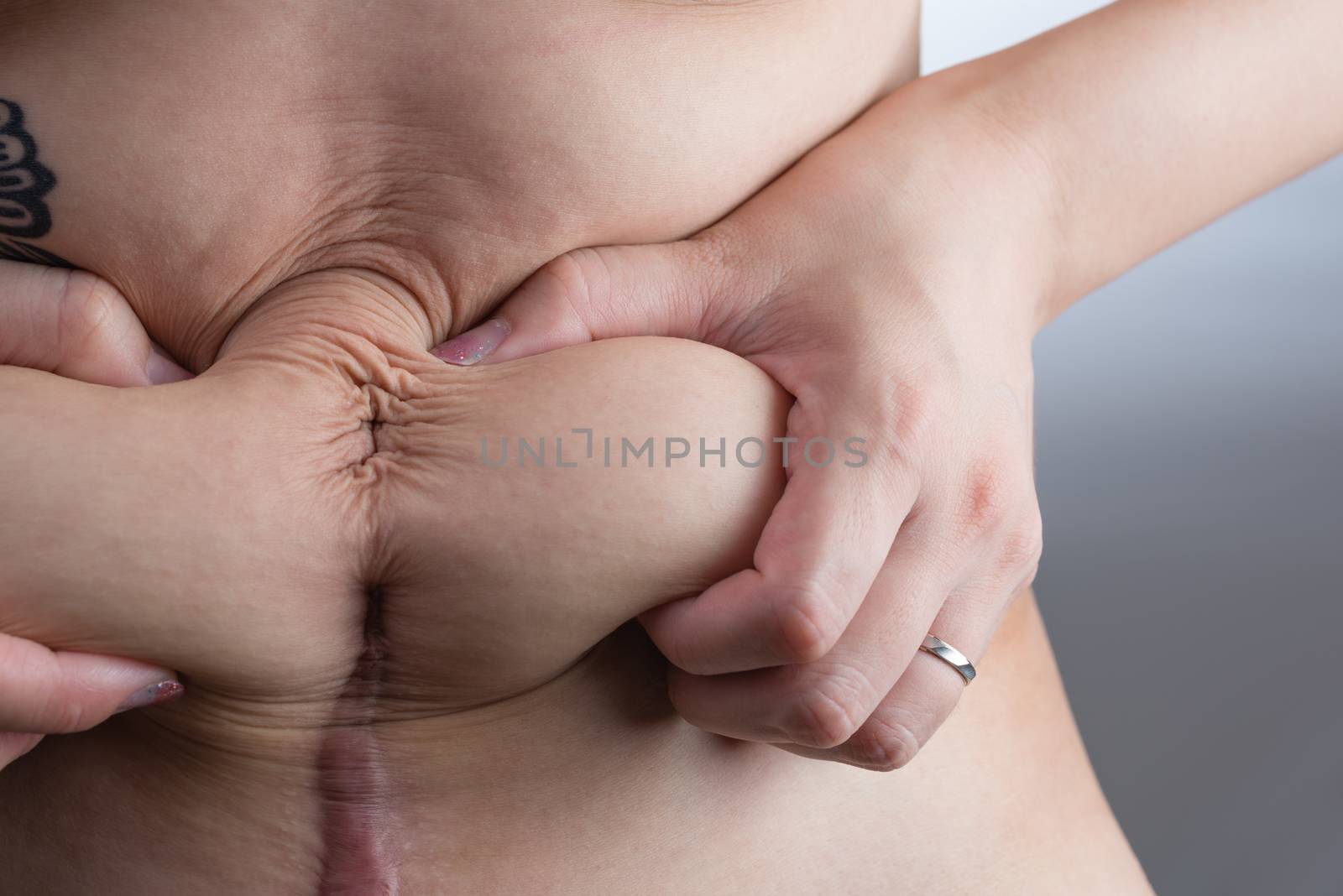 Stomach After a C-Section by justtscott