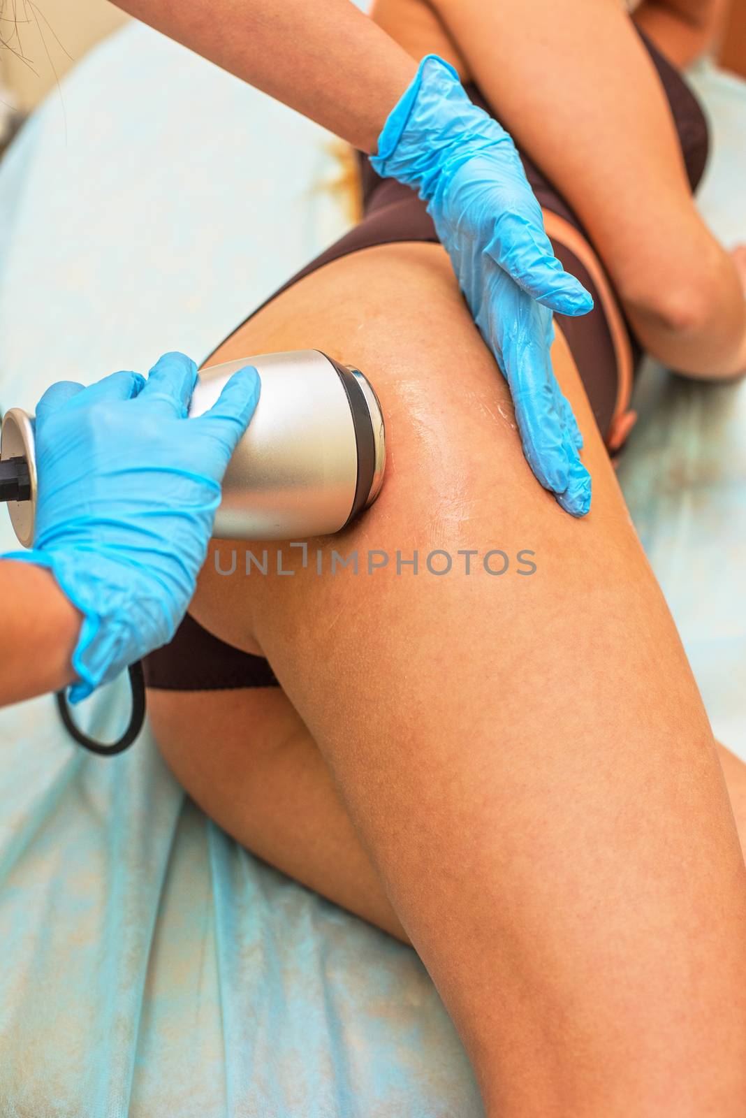 procedure for women hip for cellulite and fat