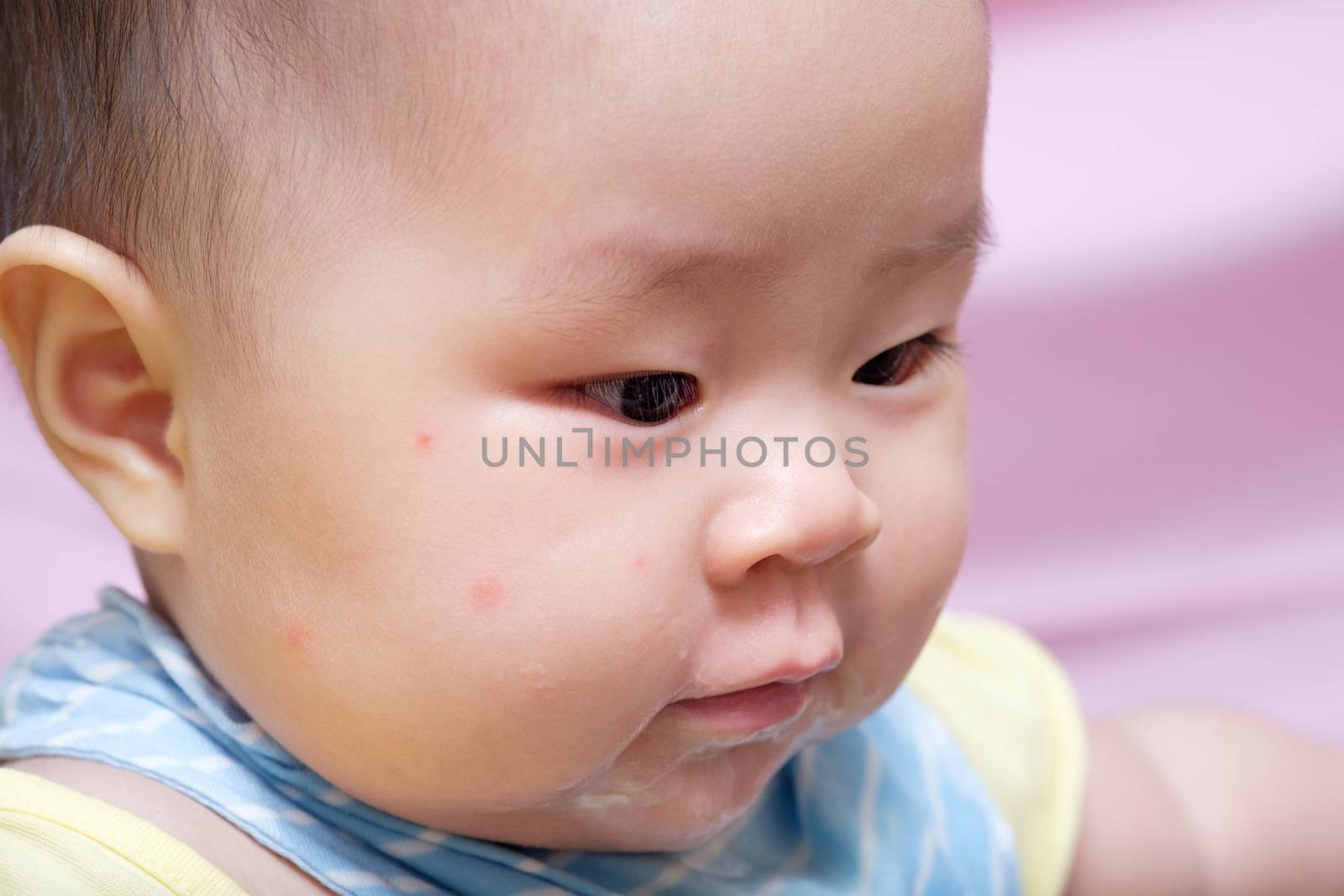 Mosquito bite Asian baby girl by zneb076