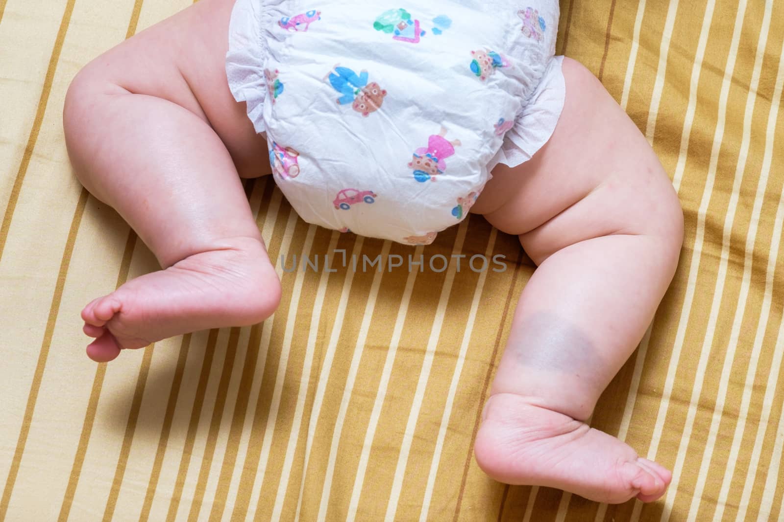 Birthmark on Asian baby girl legs by zneb076