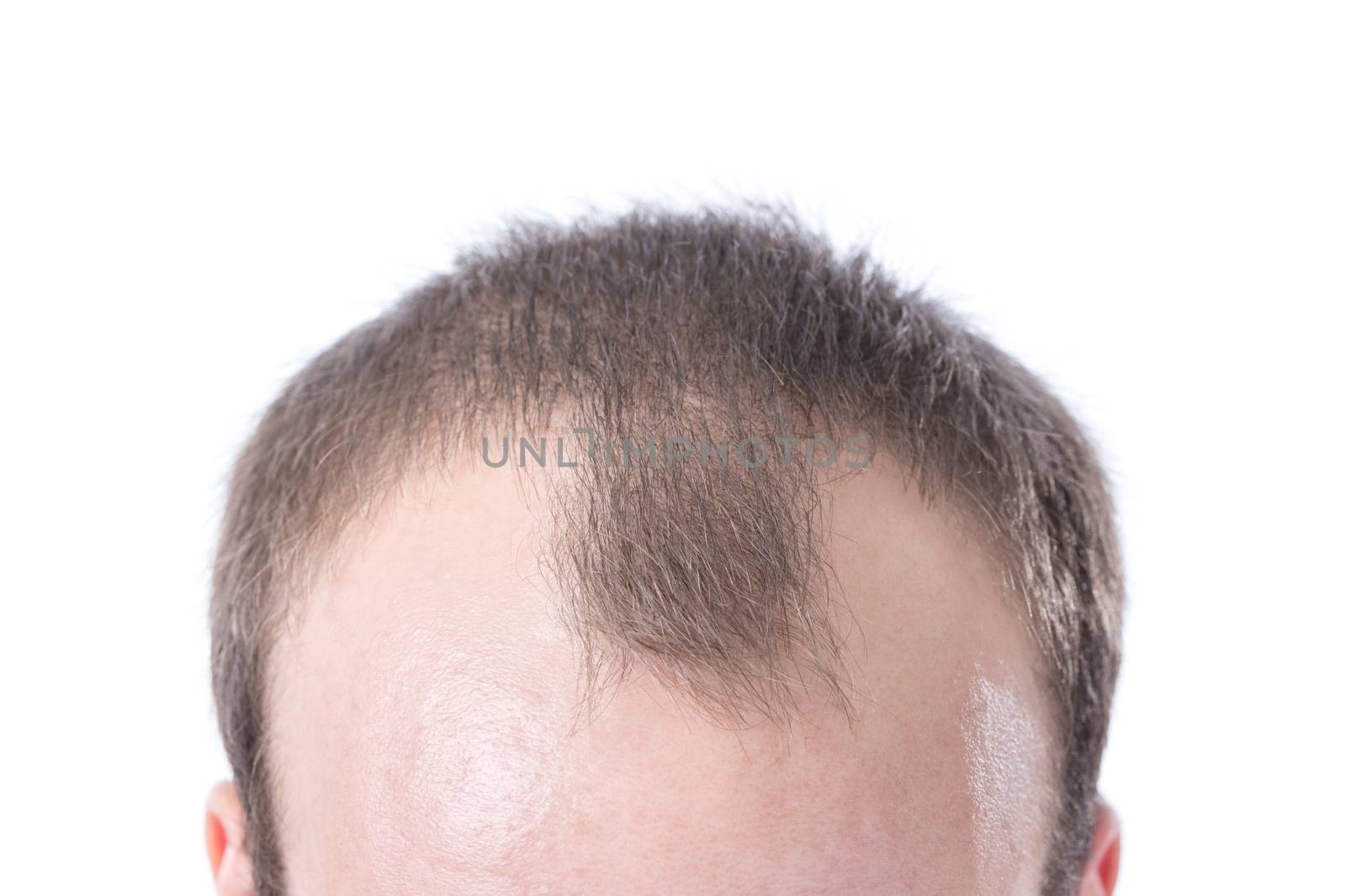 A white male with brown hair's receding hairline on a white background.