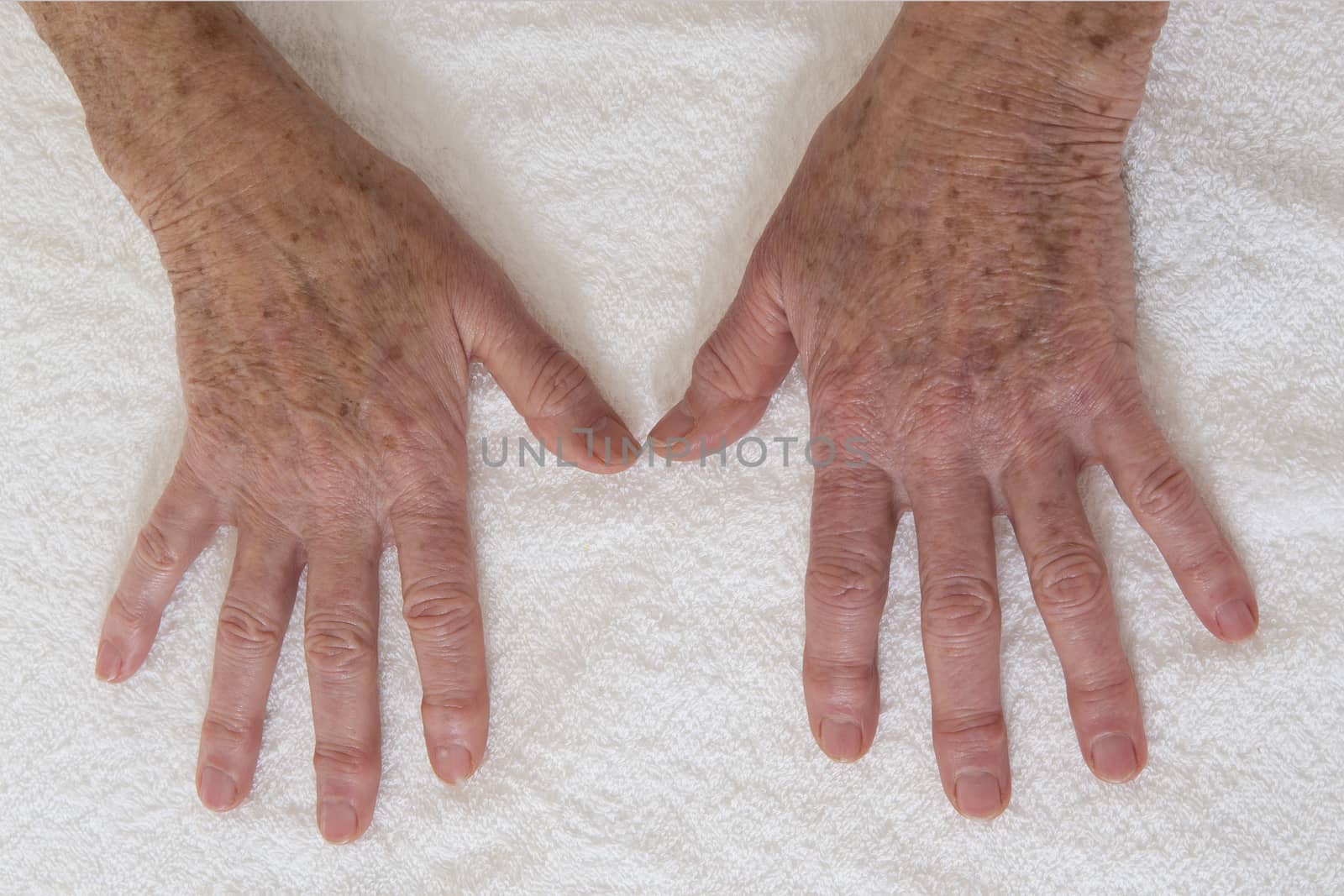 old stain on the skin- Skin disease on hands