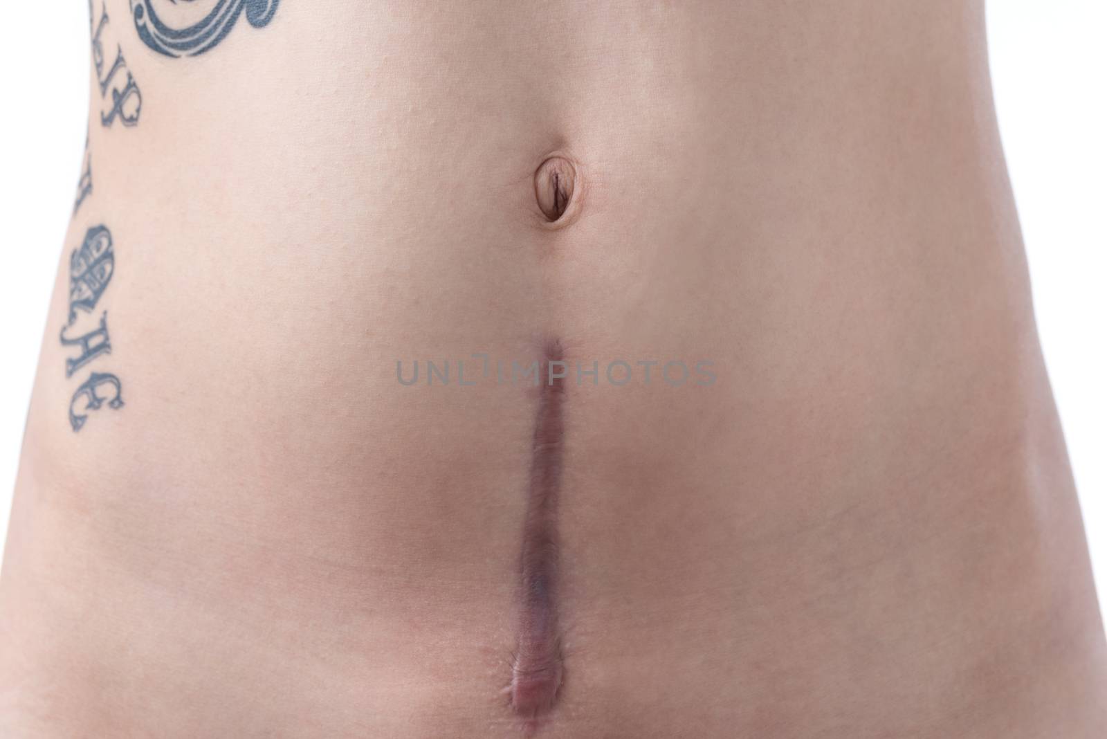 A woman with a tattoo's scar from a c-section birth on a white background.