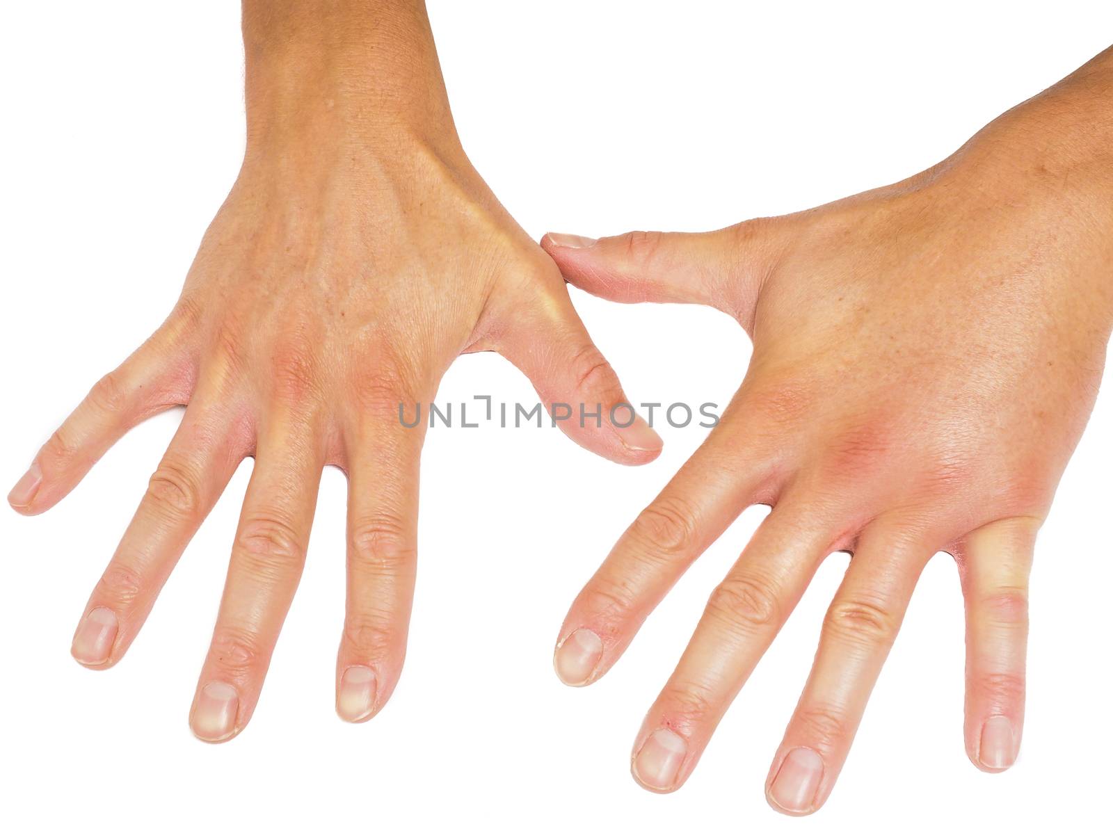 Comparing swollen male hands isolated towards white background by Arvebettum