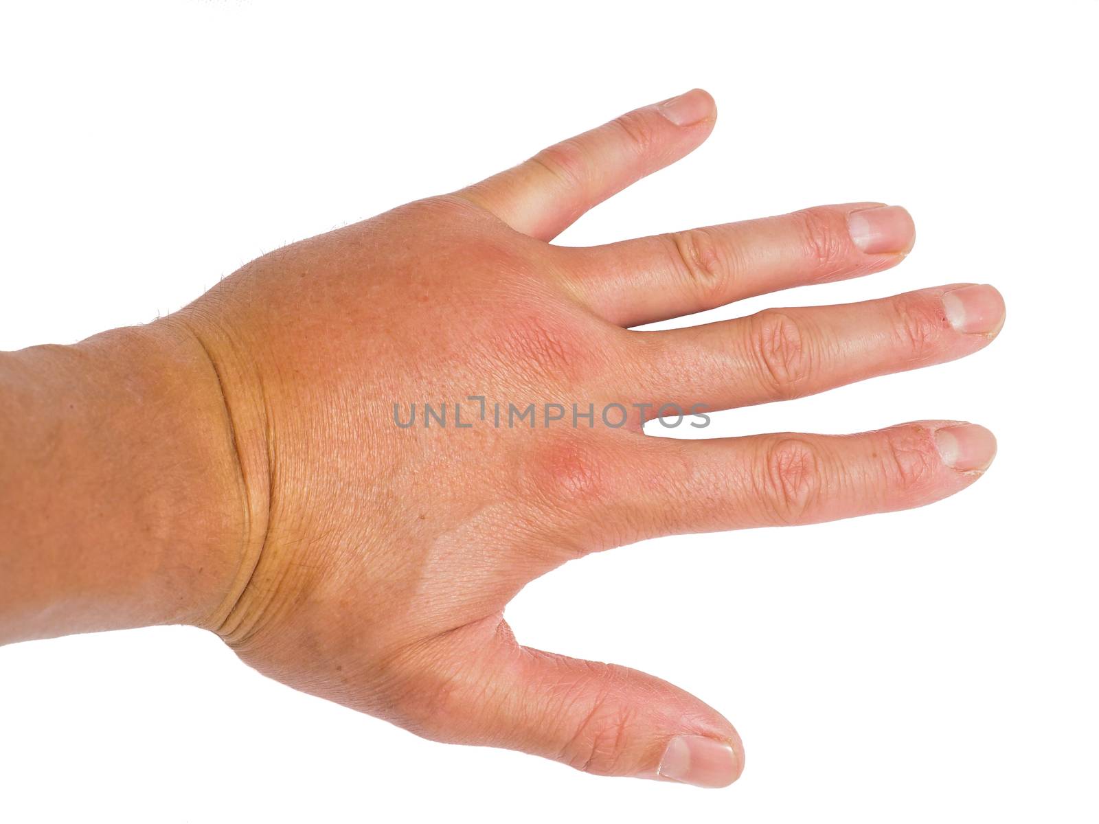 Male person showing swollen knuckles on left hand isolated on white