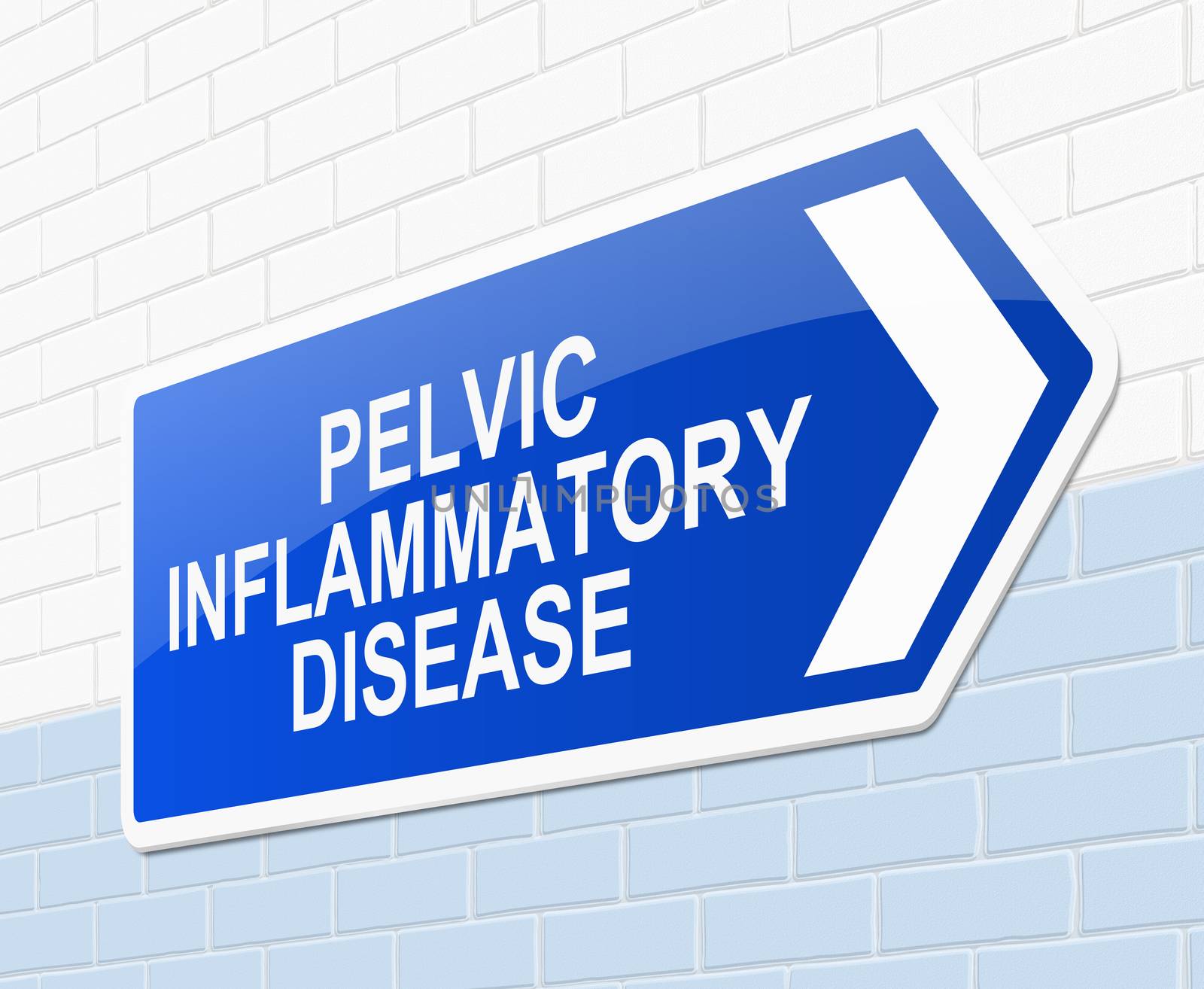 Illustration depicting a sign with a pelvic inflammatory disease concept.
