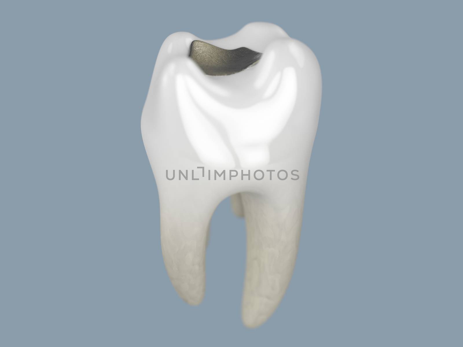 A close up of 3D rendering of a tooth with a filling on a grey backround