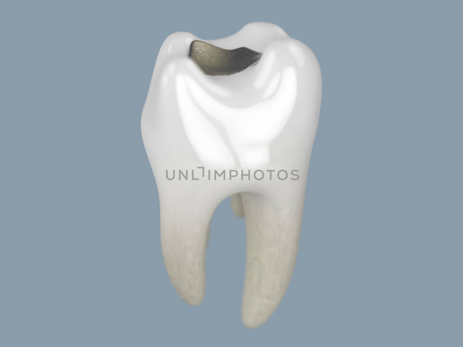 tooth with filling  by stockbp