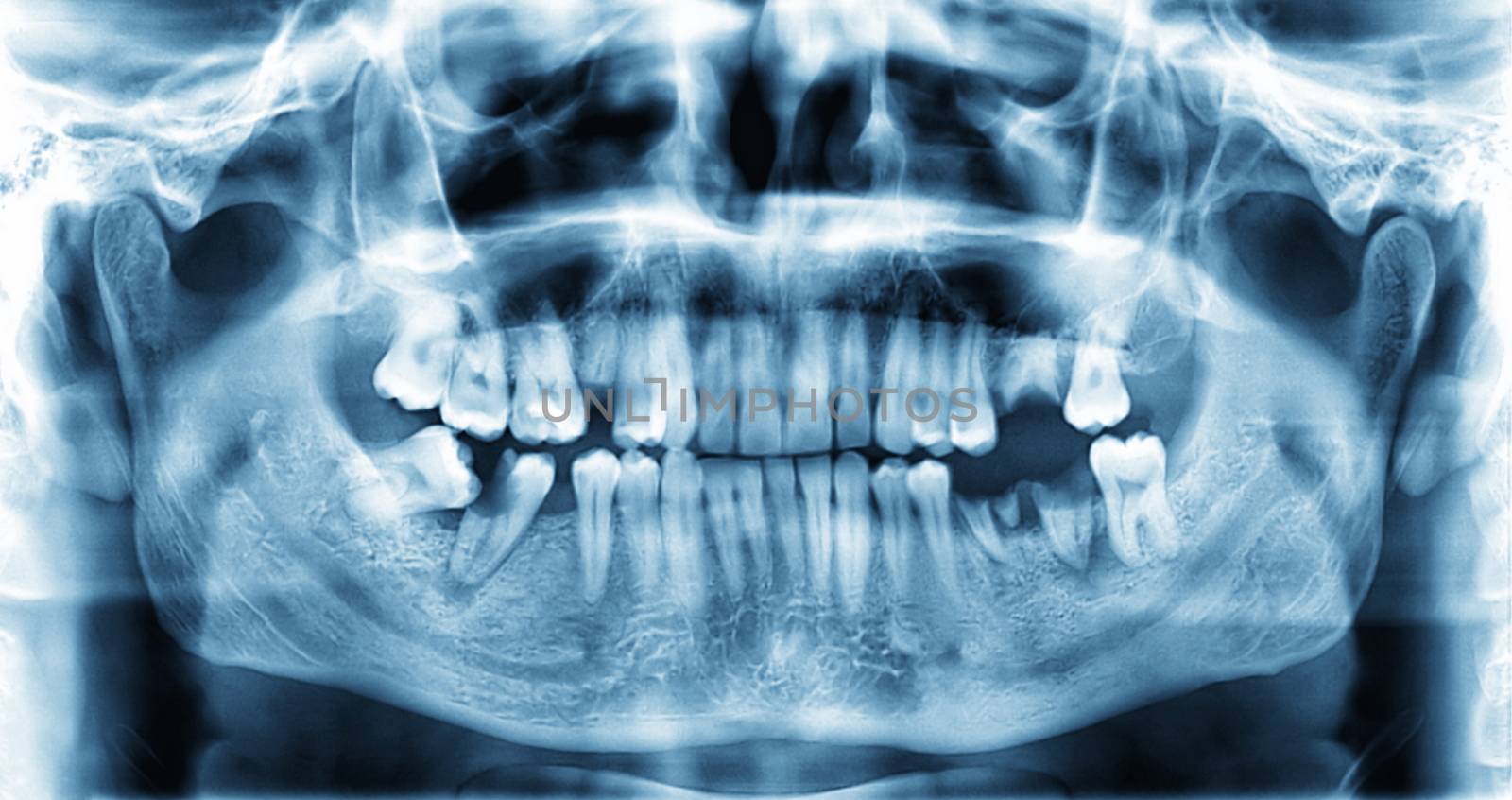 Panoramic dental x-ray image of teeth. by Attila