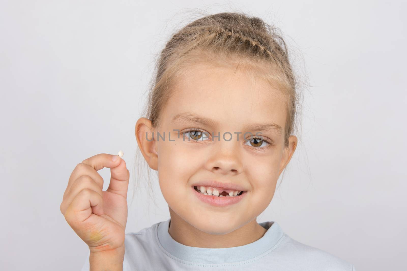 Six year old girl showing her fallen Milk front upper teeth