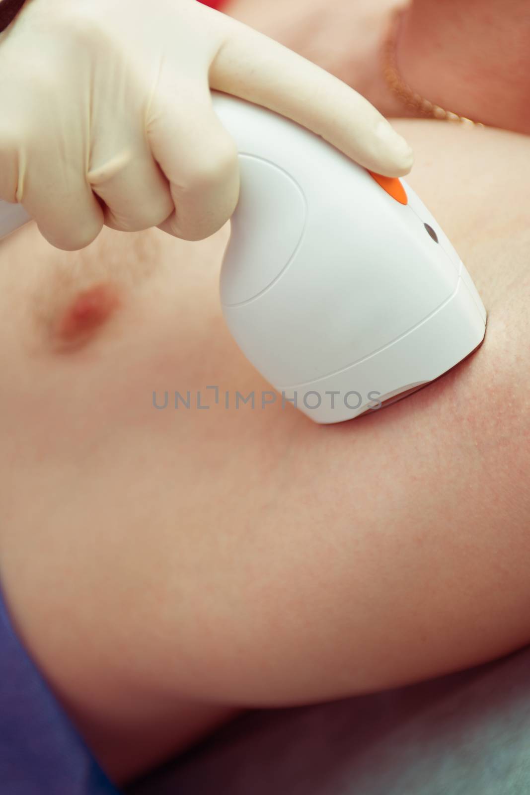 man receiving laser epilation at armpit on beauty center