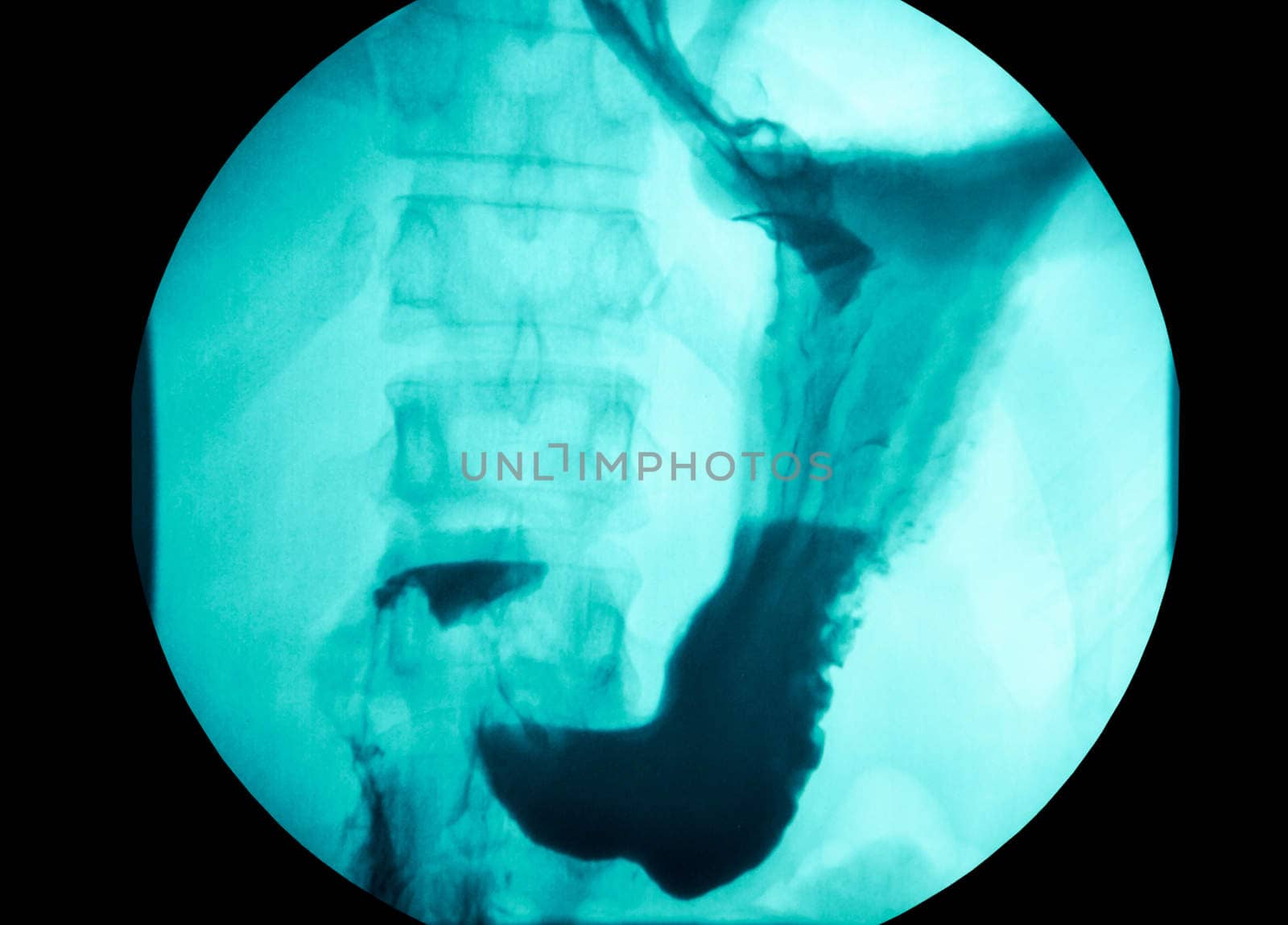 picture of intestinal abdominal xray
