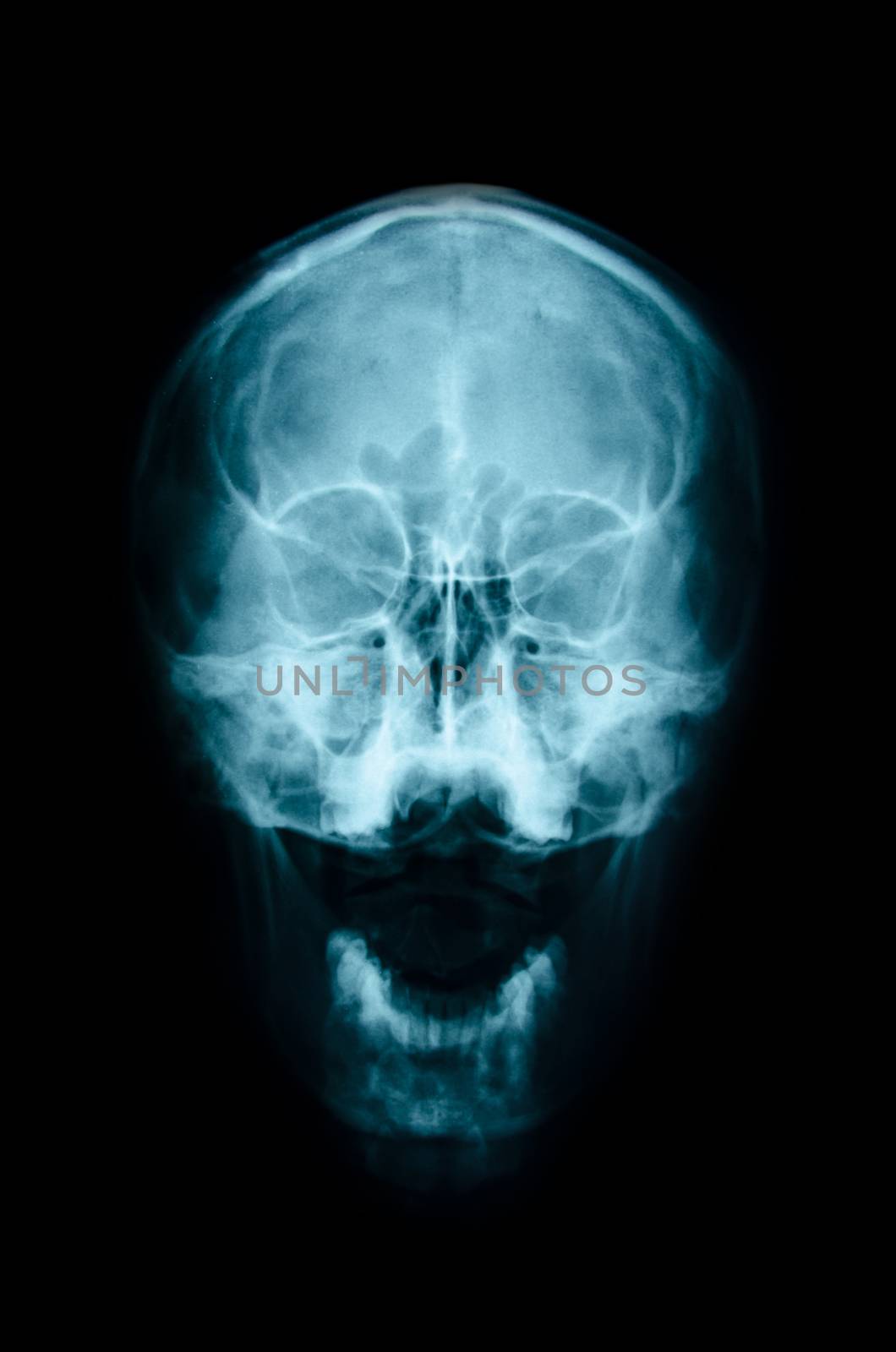 film x-ray Skull AP : show normal human's skull and blank area at front side