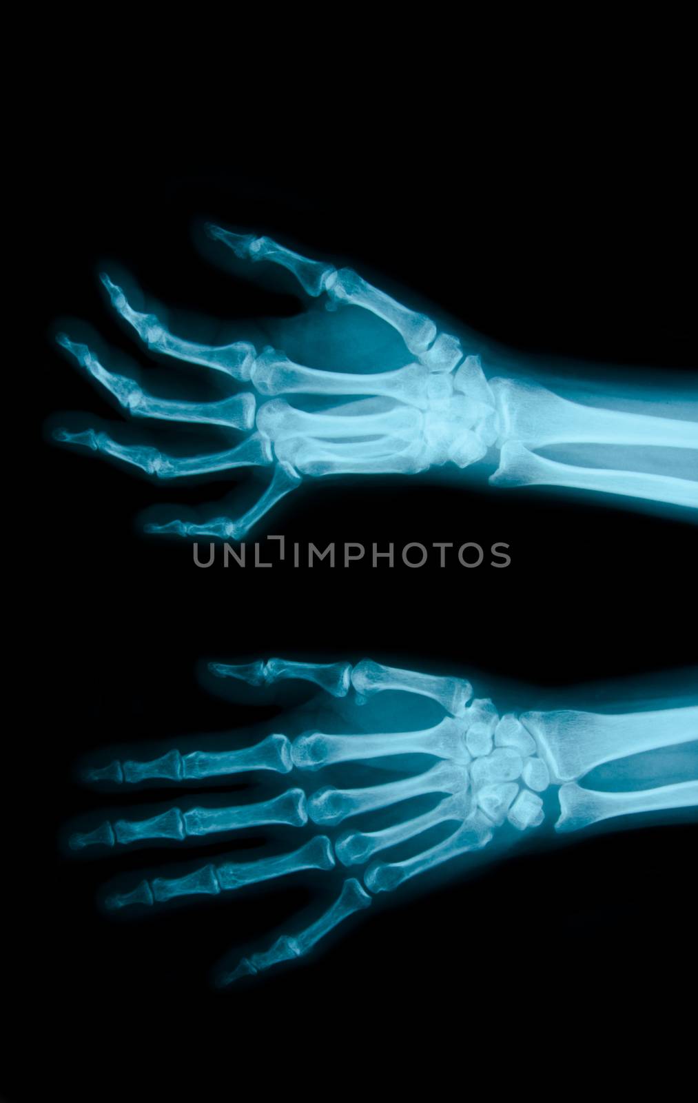 Film X-ray show bones by Gamjai