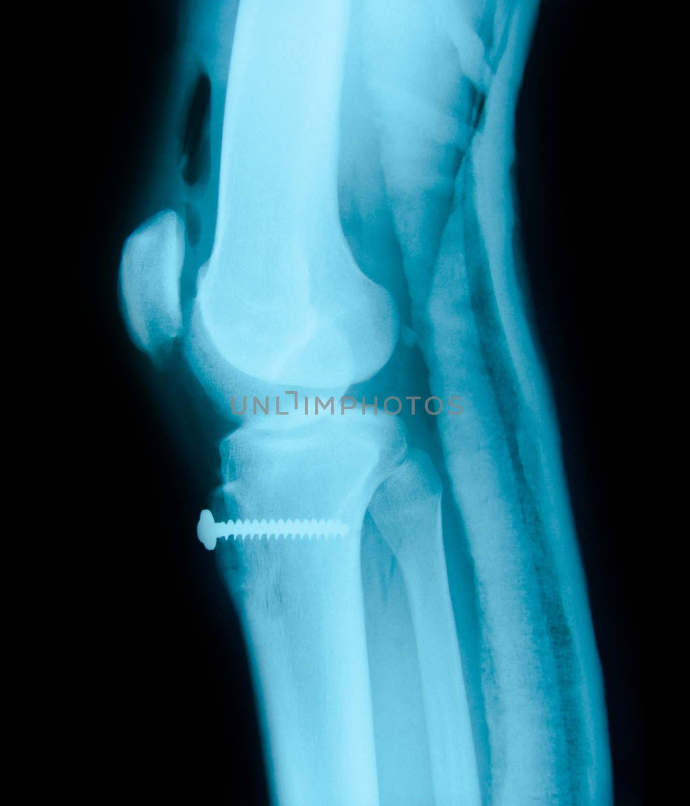 Right knee joint and Medical equipment X-ray by Gamjai