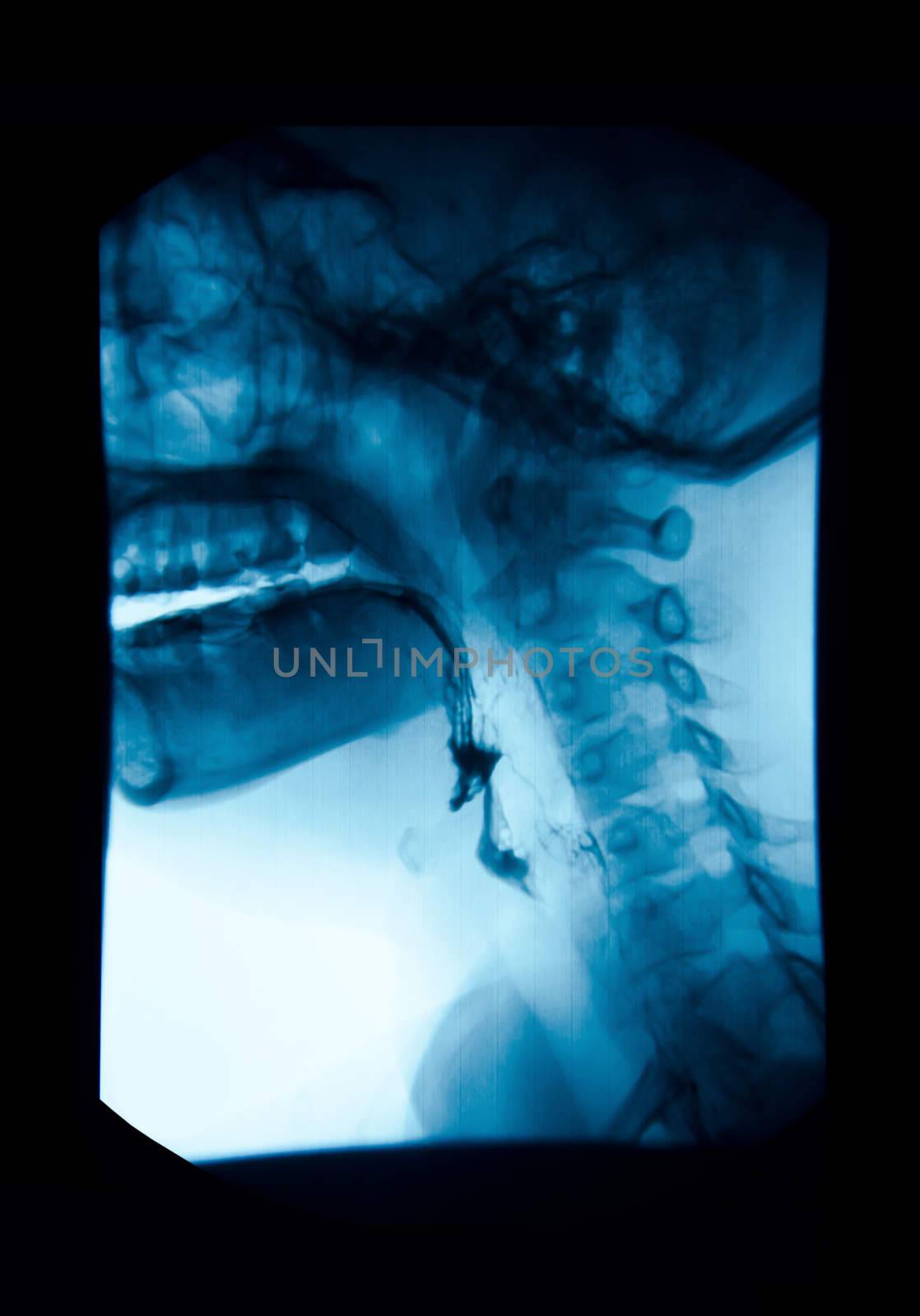The image of x-ray upper gastrointestinal (UGI), Esophagram. by Gamjai